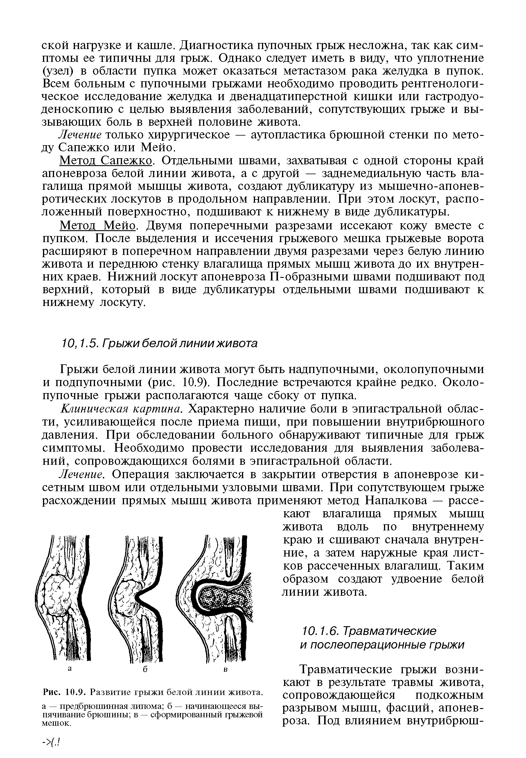 Рис. 10.9. Развитие грыжи белой линии живота, а — предбрюшинная липома б — начинающееся выпячивание брюшины в — сформированный грыжевой мешок.