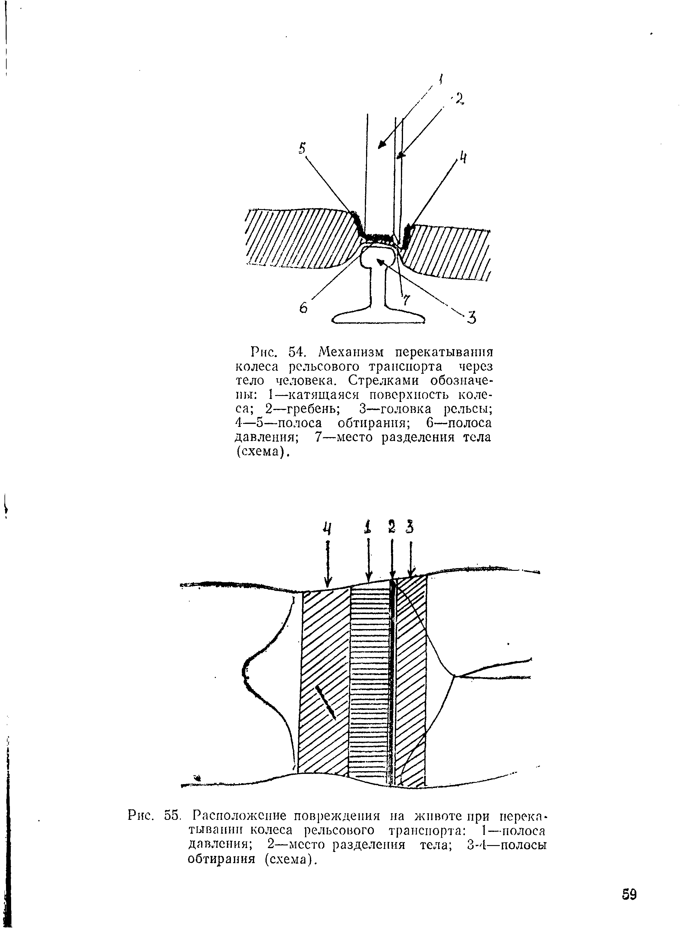 Рис. 55. Расположение повреждения на животе при перекатывании колеса рельсового транспорта 1—полоса давления 2—место разделения тела 3-4—полосы обтирания (схема).
