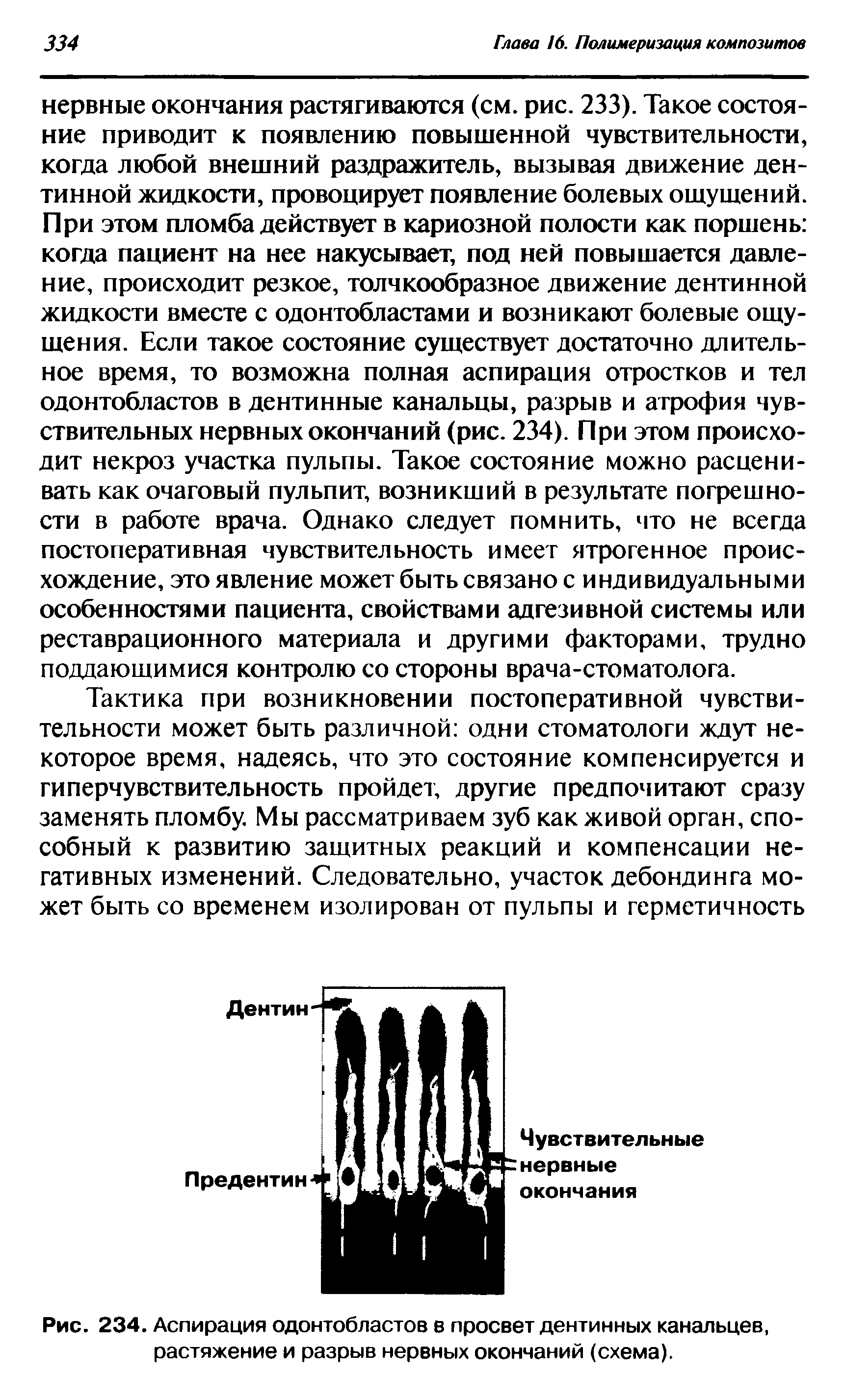 Рис. 234. Аспирация одонтобластов в просвет дентинных канальцев, растяжение и разрыв нервных окончаний (схема).