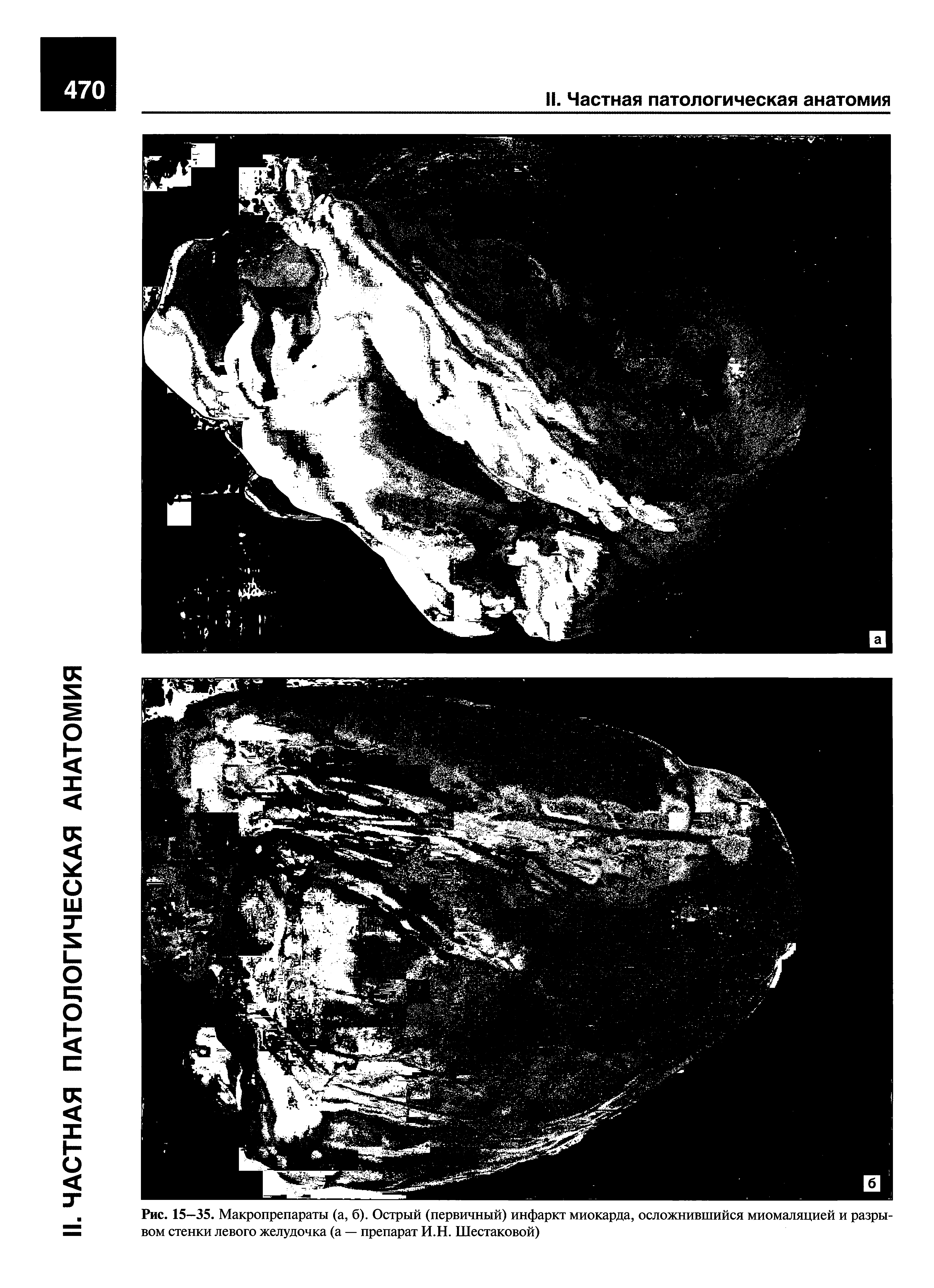 Рис. 15—35. Макропрепараты (а, б). Острый (первичный) инфаркт миокарда, осложнившийся миомаляцией и разрывом стенки левого желудочка (а — препарат И.Н. Шестаковой)...