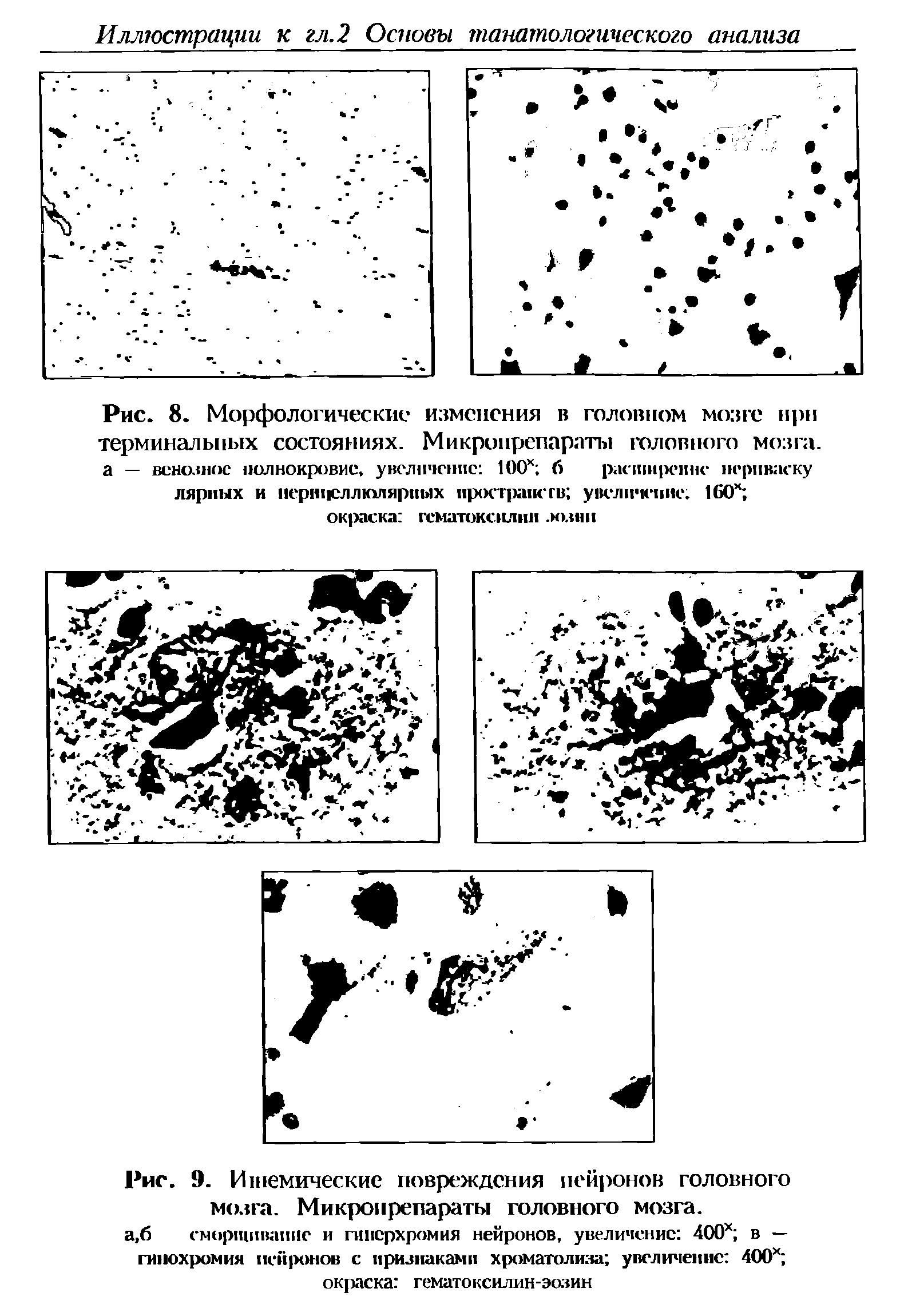 Рис. 9. Ишемические повреждения нейронов головного мозга. Микропрепараты головного мозга.