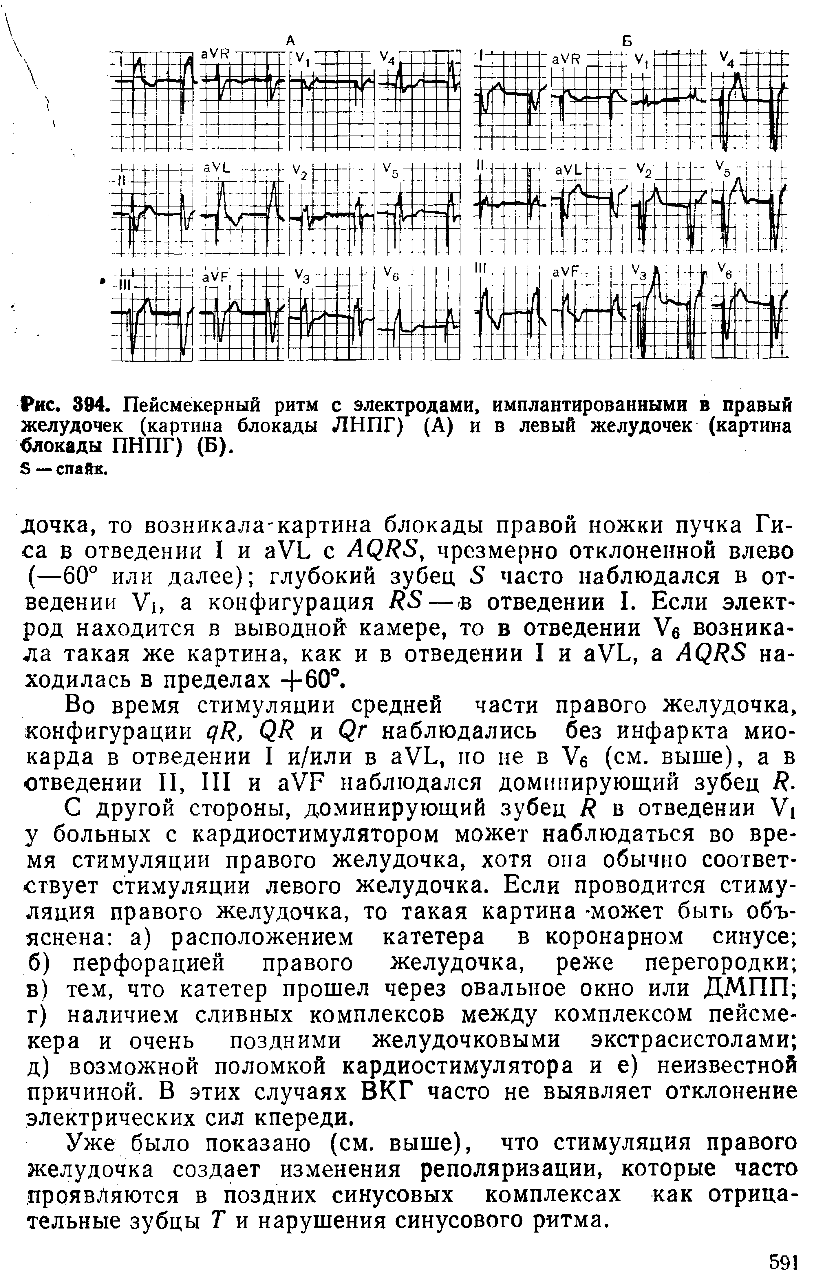 Рис. 394. Пейсмекерный ритм с электродами, имплантированными в правый желудочек (картина блокады ЛНПГ) (А) и в левый желудочек (картина блокады ПНПГ) (Б).