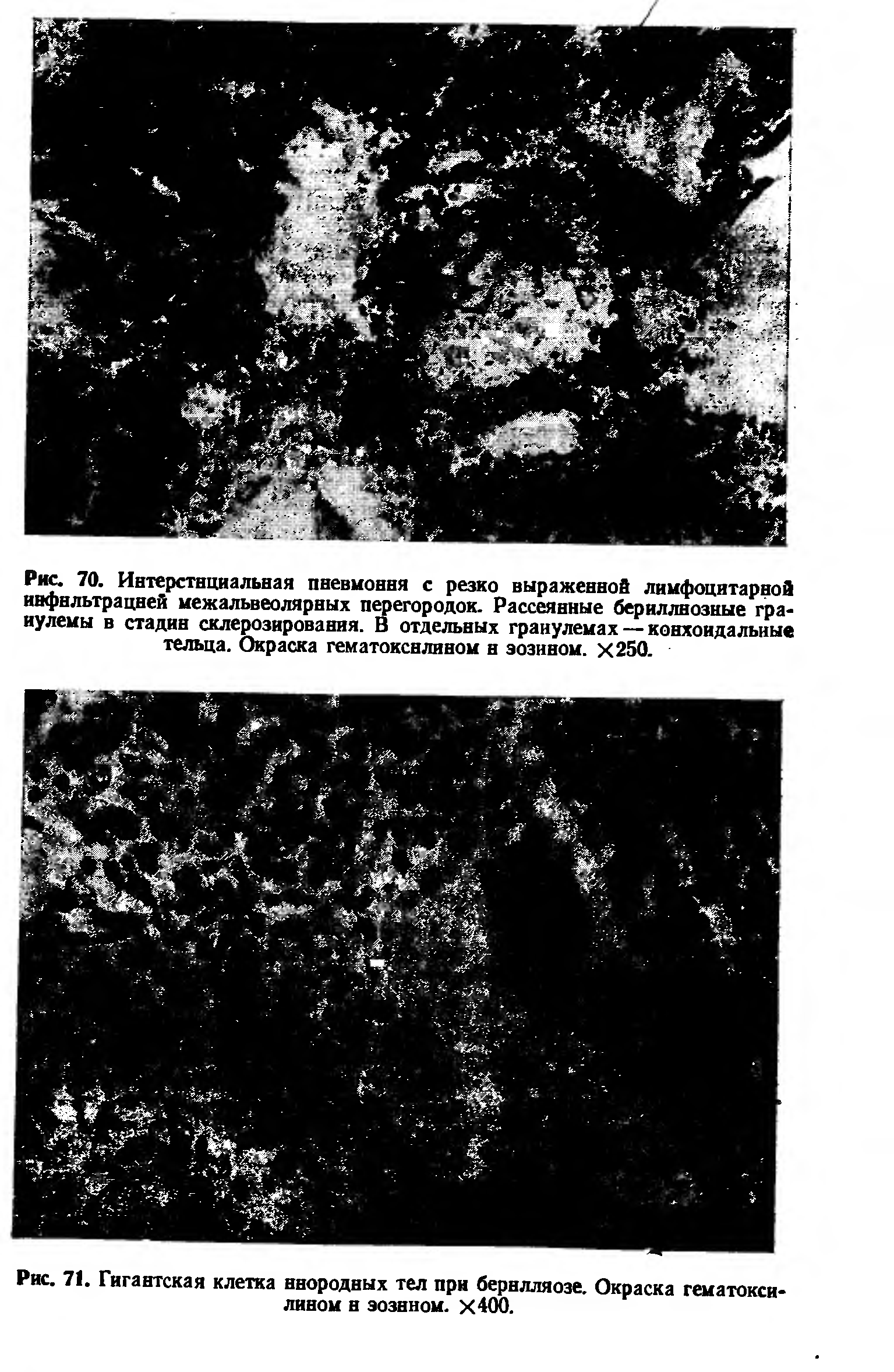 Рис. 71. Гигантская клетка инородных тел при бернлляозе. Окраска гематоксилином н эозином. Х400.