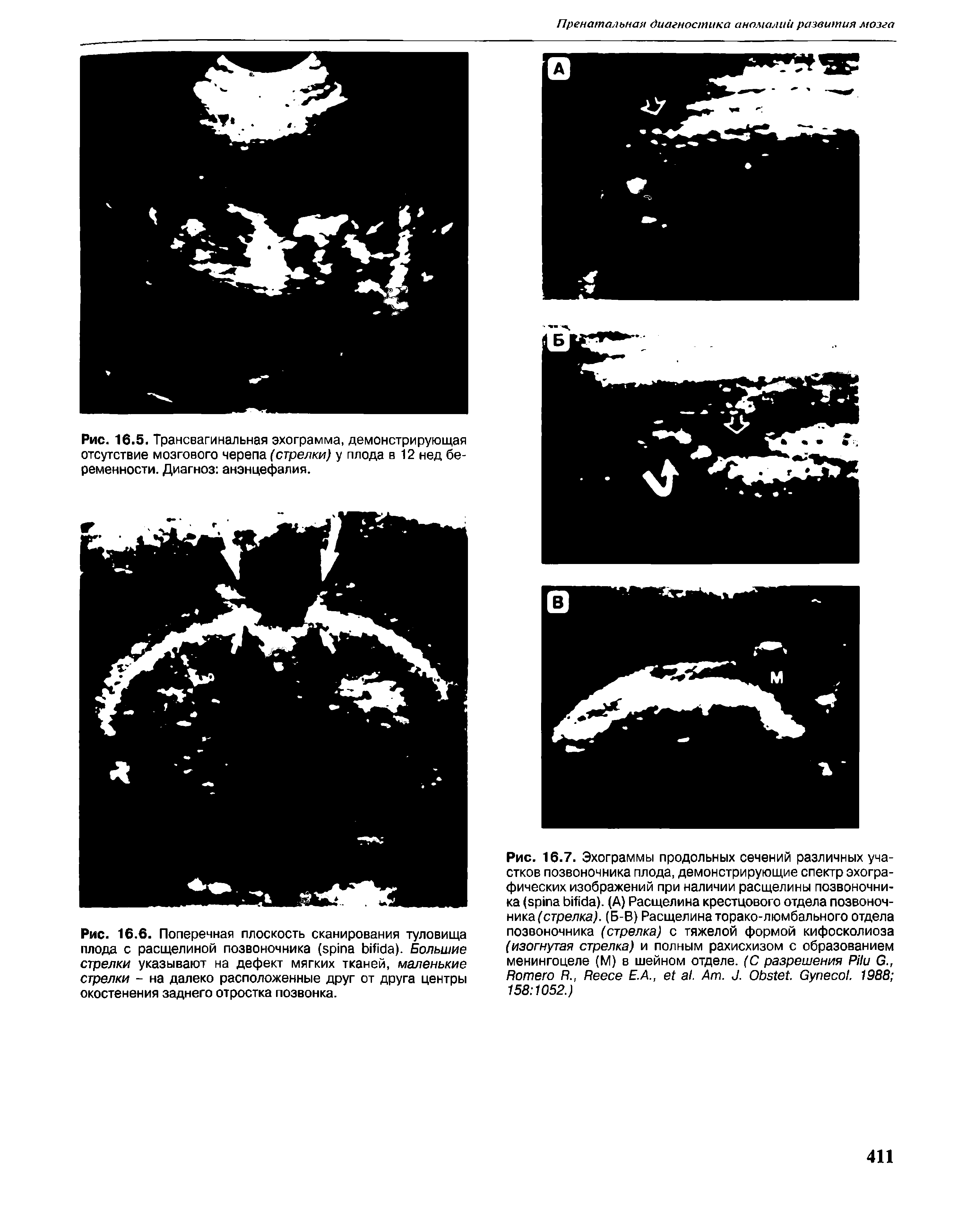 Рис. 16.6. Поперечная плоскость сканирования туловища плода с расщелиной позвоночника ( ). Большие стрелки указывают на дефект мягких тканей, маленькие стрелки - на далеко расположенные друг от друга центры окостенения заднего отростка позвонка.