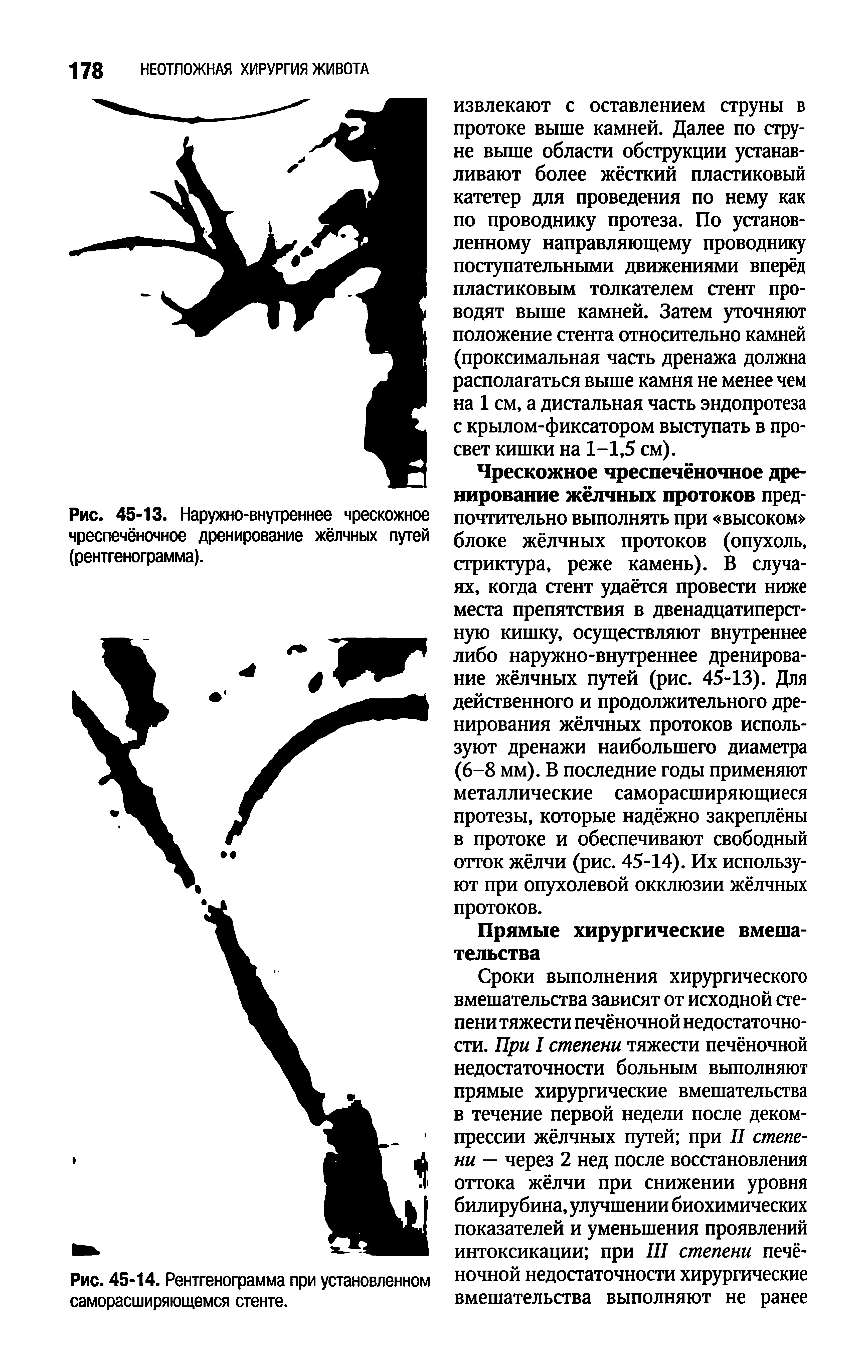 Рис. 45-13. Наружно-внутреннее чрескожное чреспечёночное дренирование жёлчных путей (рентгенограмма).