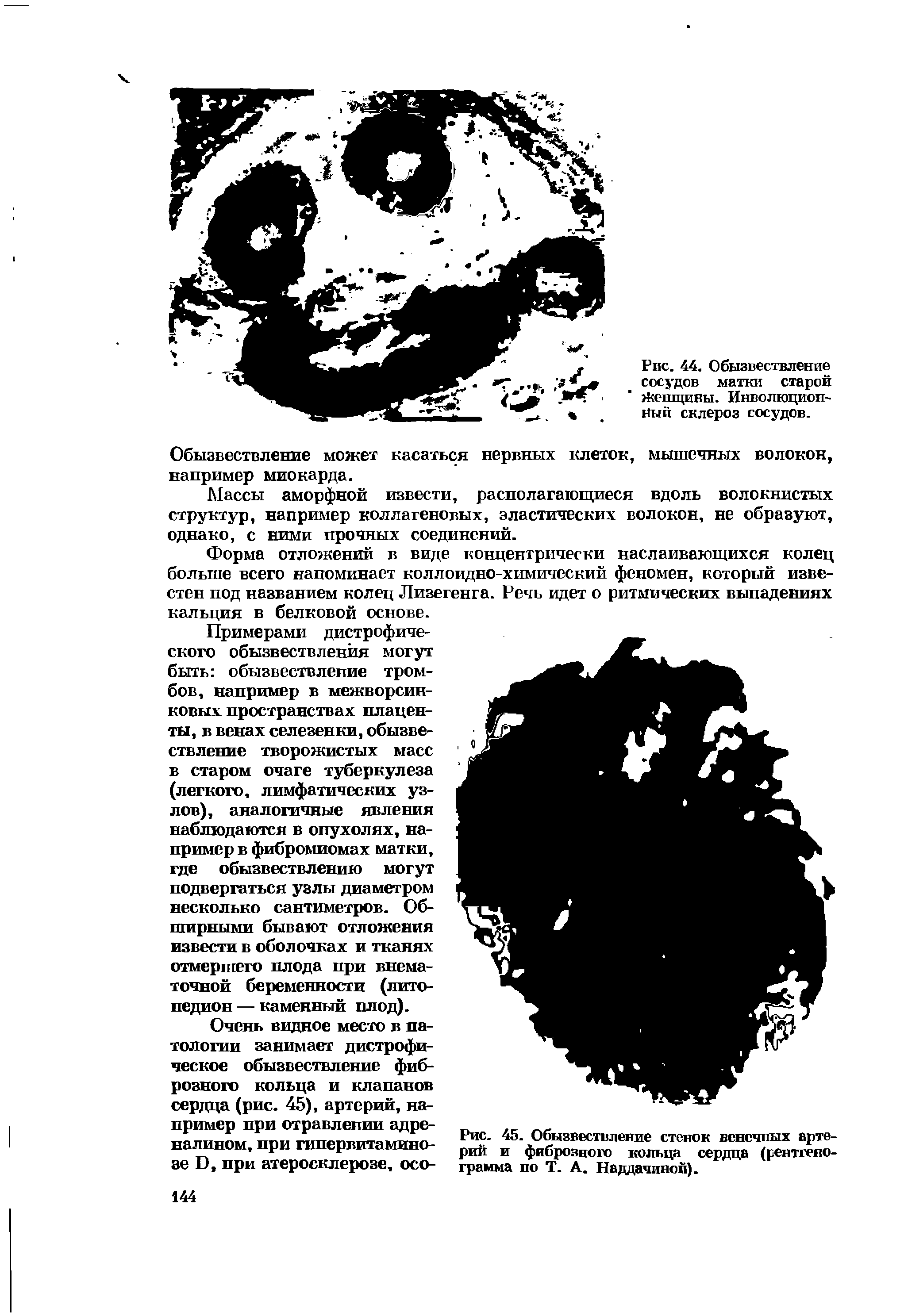 Рис. 44. Обызвествление сосудов матки старой Женщины. Инволюционный склероз сосудов.