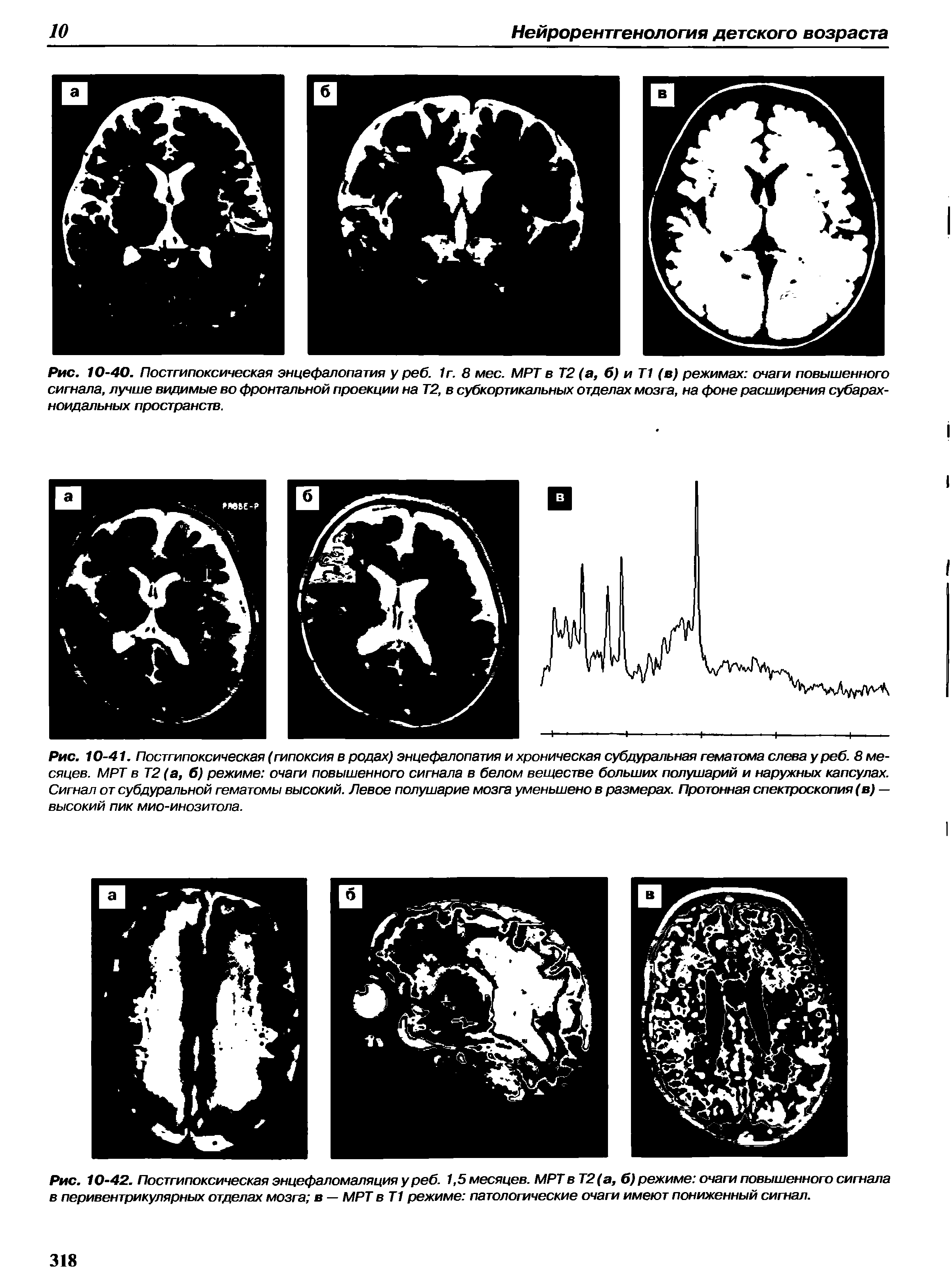 Рис. 10-42. Постгипоксическая энцефаломаляция у реб. 1,5 месяцев. МРТ вТ2(а, б) режиме очаги повышенного сигнала в перивентрикулярных отделах мозга в — МРТ в Т1 режиме патологические очаги имеют пониженный сигнал.