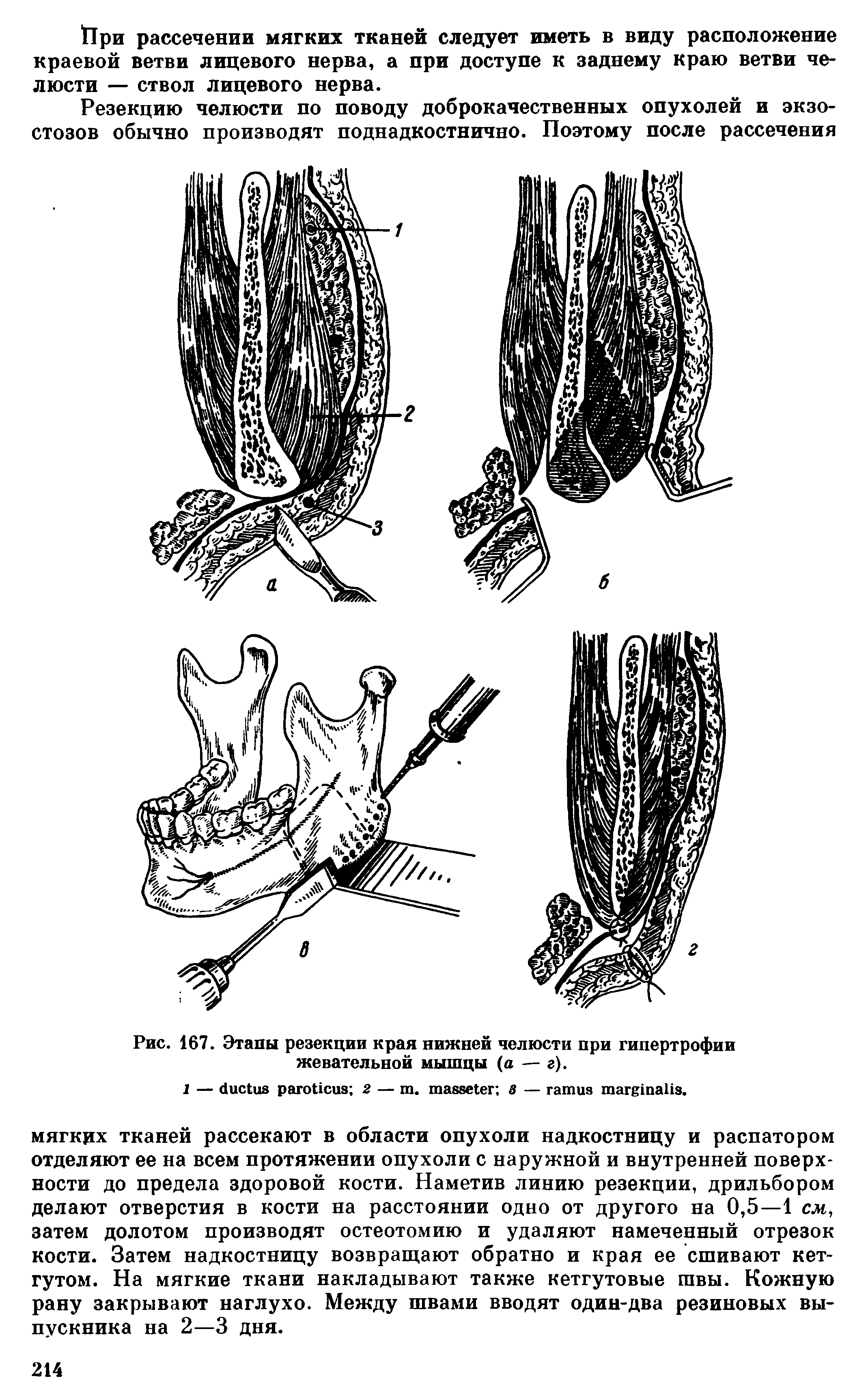 Рис. 167. Этапы резекции края нижней челюсти при гипертрофии жевательной мышцы (а — г).