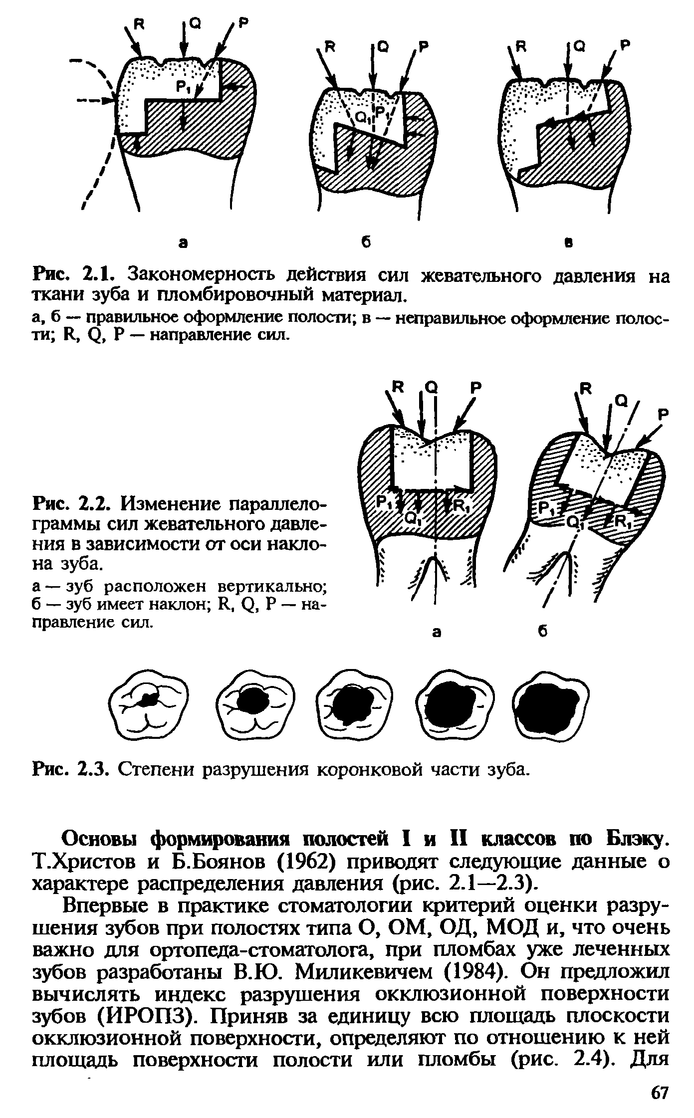 Рис. 2.2. Изменение параллелограммы сил жевательного давления в зависимости от оси наклона зуба.