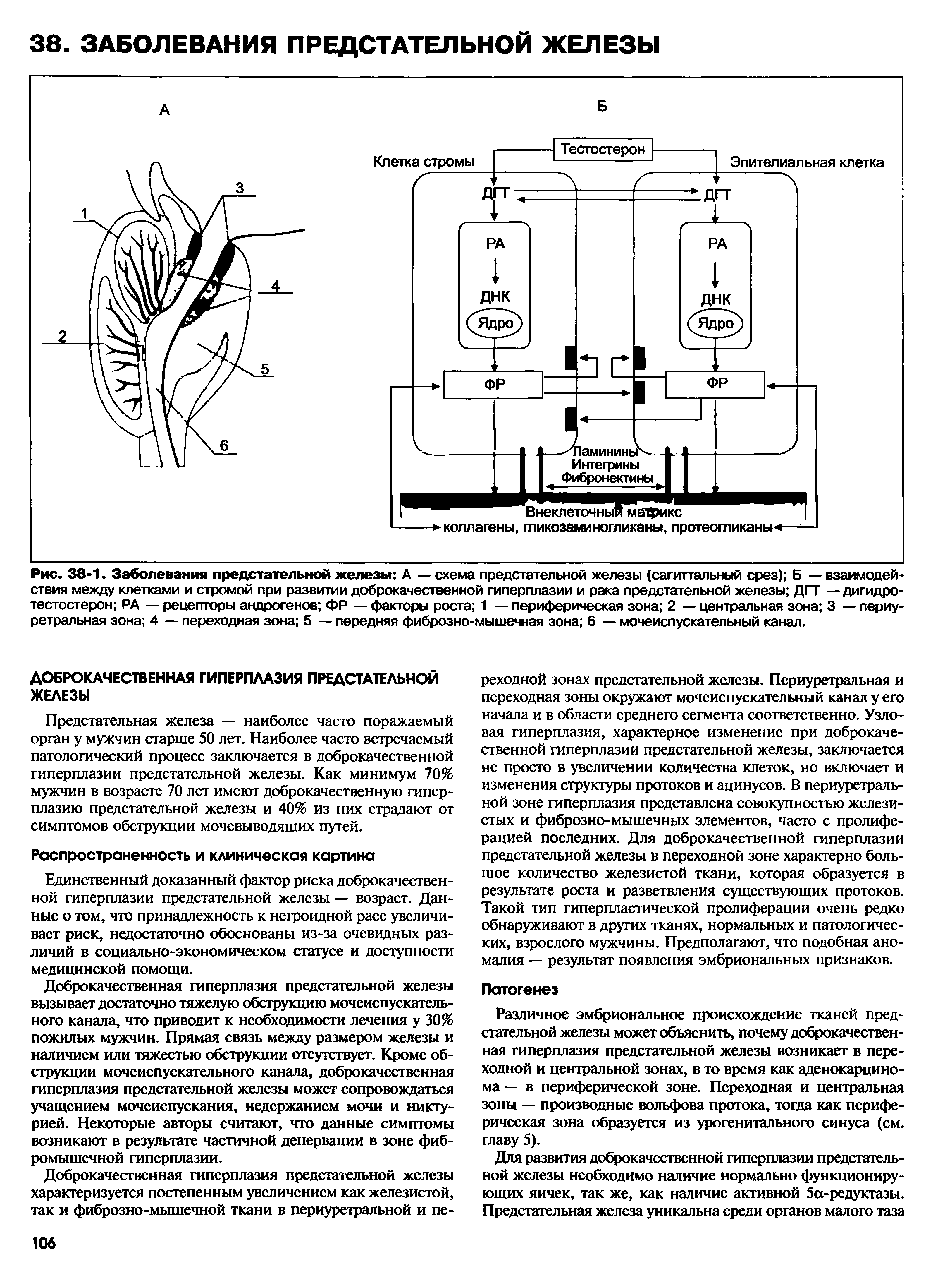 Рис. 38-1. Заболевания предстательной железы А — схема предстательной железы (сагиттальный срез) Б — взаимодействия между клетками и стромой при развитии доброкачественной гиперплазии и рака предстательной железы ДГТ — дигидротестостерон РА — рецепторы андрогенов ФР — факторы роста 1 — периферическая зона 2 — центральная зона 3 — периу-ретральная зона 4 — переходная зона 5 — передняя фиброзно-мышечная зона 6 — мочеиспускательный канал.