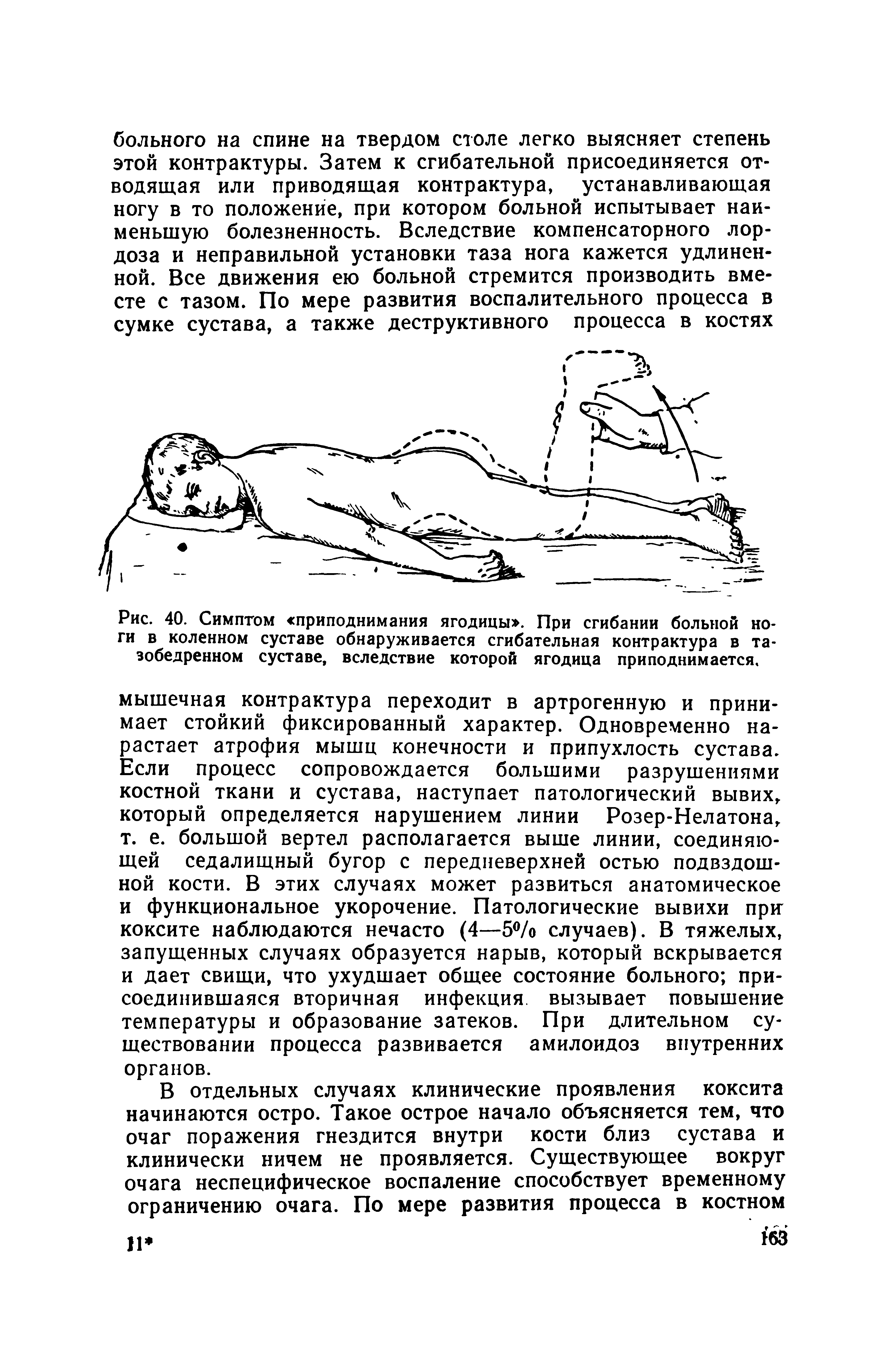 Рис. 40. Симптом приподнимания ягодицы . При сгибании больной ноги в коленном суставе обнаруживается сгибательная контрактура в тазобедренном суставе, вследствие которой ягодица приподнимается.