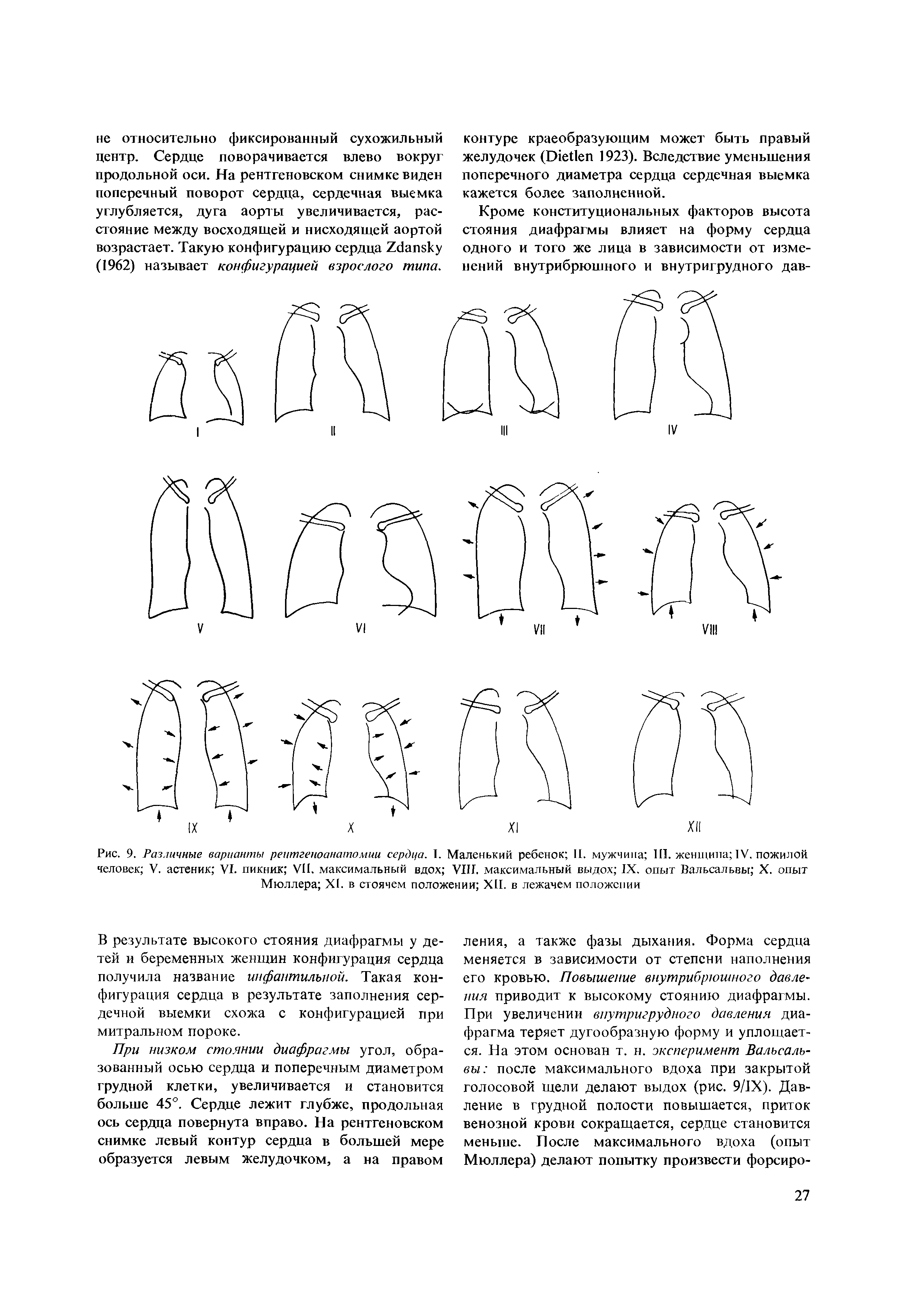 Рис. 9. Различные варианты реитгеноанатолши сердца. I. Маленький ребенок II. мужчина III. женщина IV. пожилой человек V. астеник VI. пикник VII. максимальный вдох VIII. максимальный выдох IX. опыт Вальсальвы X. опыт Мюллера XI. в стоячем положении XII. в лежачем положении...