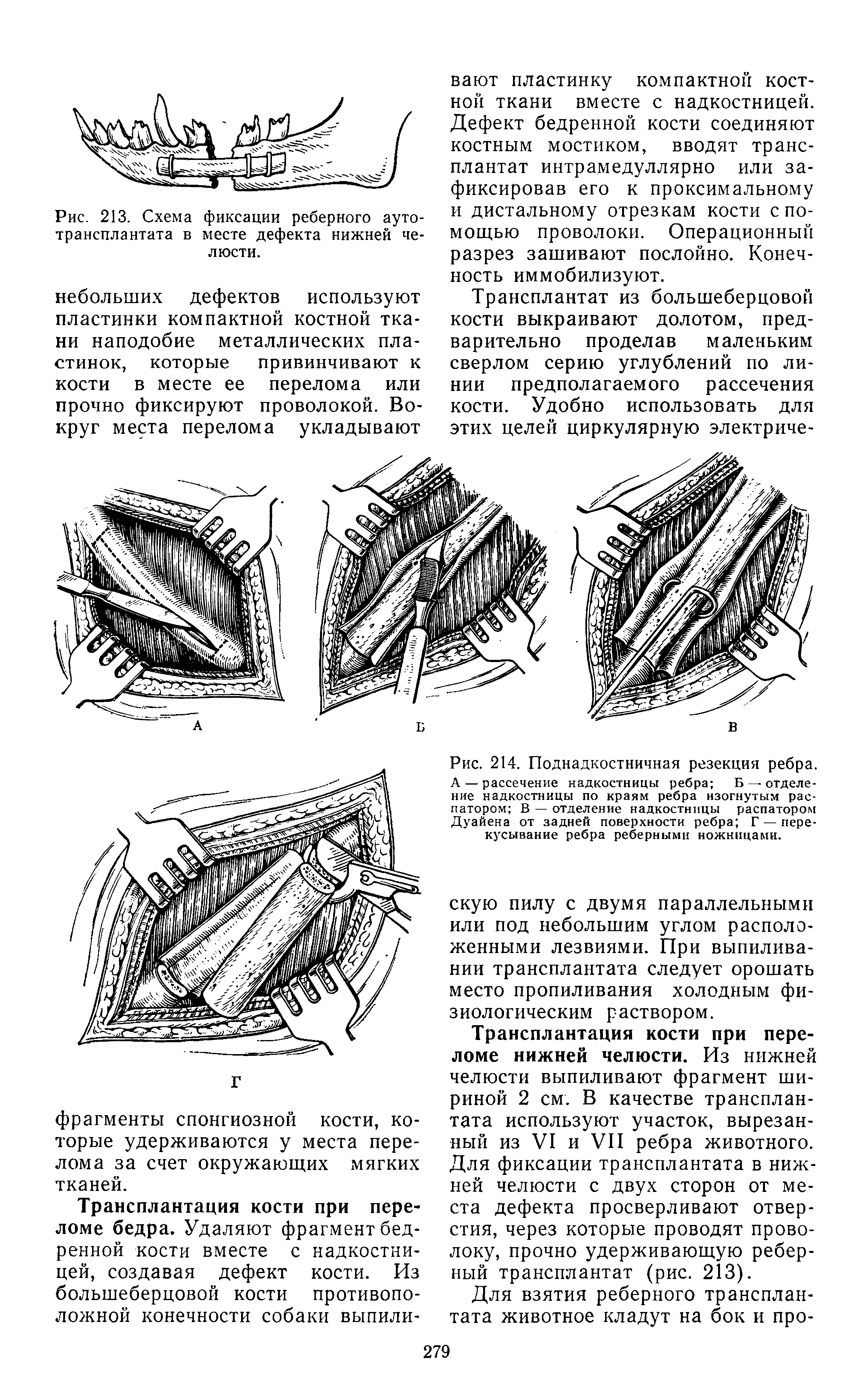 Рис. 214. Поднадкостничная резекция ребра. А — рассечение надкостницы ребра Б - отделение надкостницы по краям ребра изогнутым распатором В — отделение надкостницы распатором Дуайена от задней поверхности ребра Г — перекусывание ребра реберными ножницами.