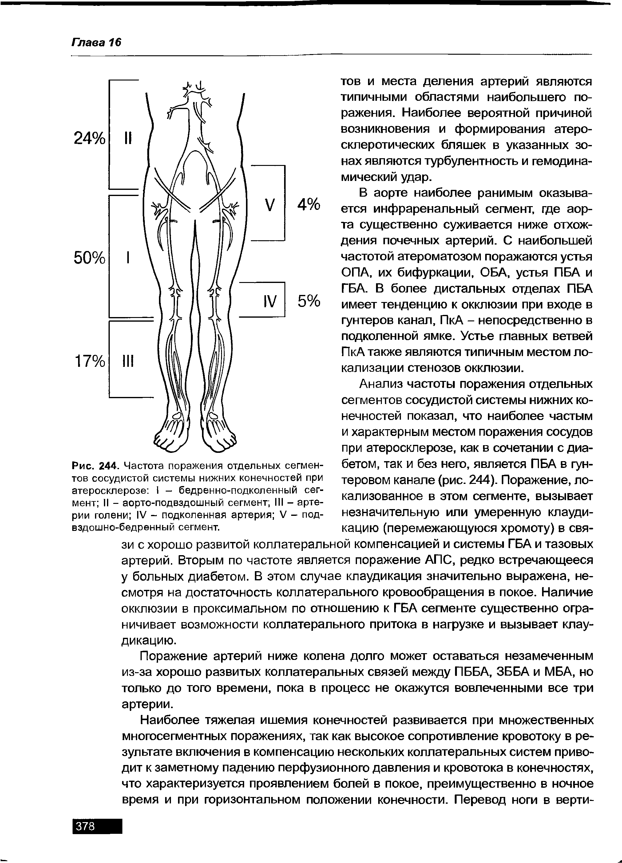 Рис. 244. Частота поражения отдельных сегментов сосудистой системы нижних конечностей при атеросклерозе I - бедренно-подколенный сегмент II - аорто-подвздошный сегмент III - артерии голени IV - подколенная артерия V - подвздошно-бедренный сегмент.