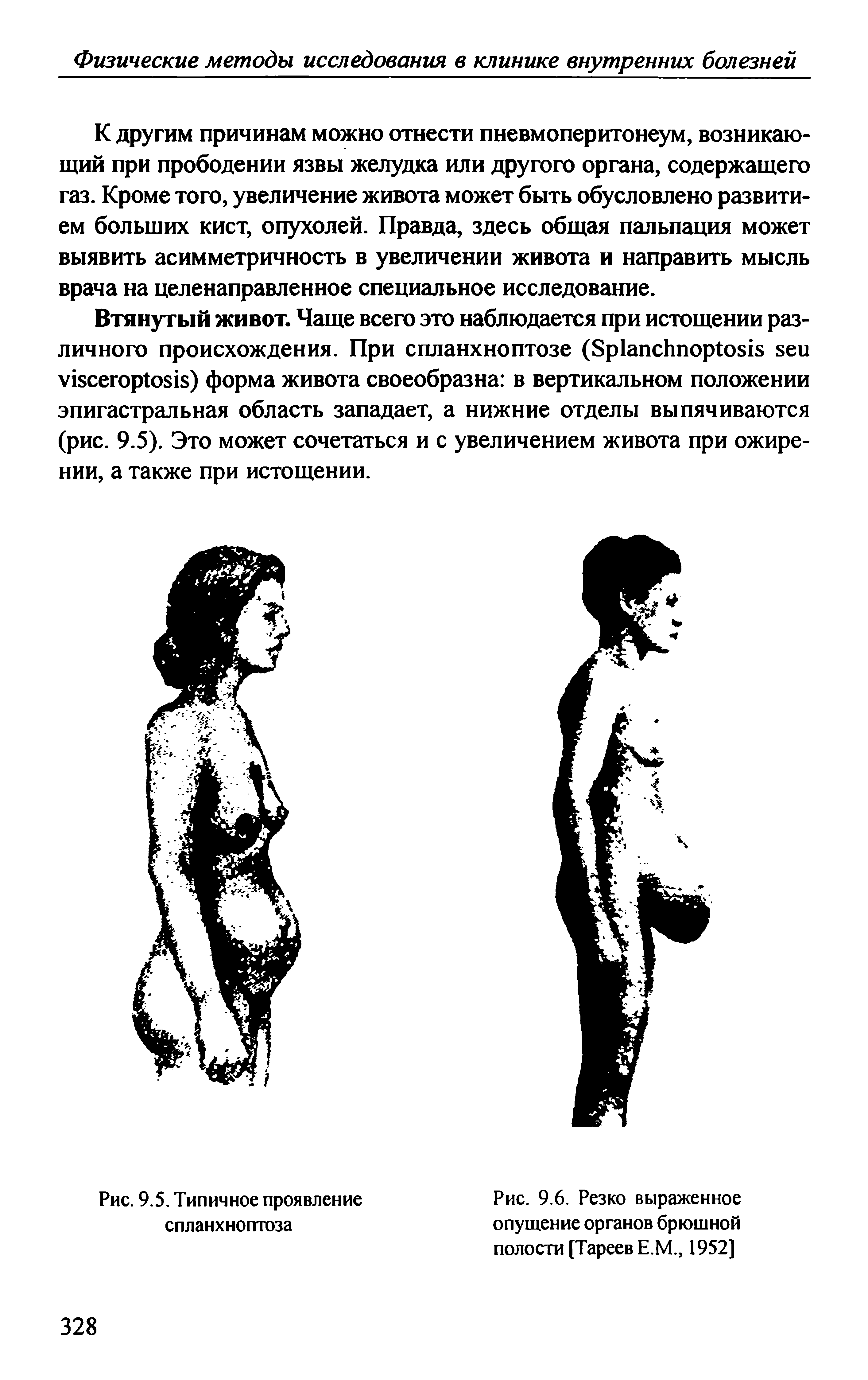 Рис. 9.6. Резко выраженное опущение органов брюшной полости [Тареев Е.М., 1952]...