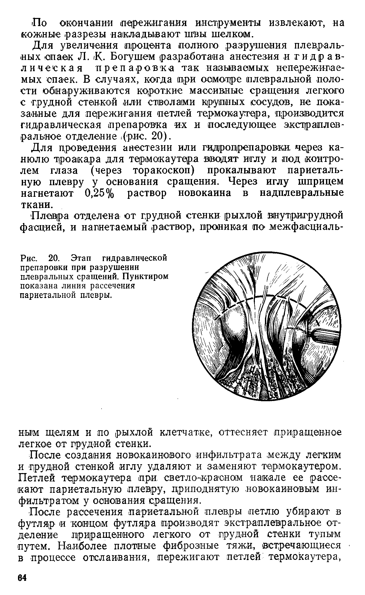 Рис. 20. Этап гидравлической препаровки при разрушении плевральных сращений. Пунктиром показана линия рассечения париетальной плевры.