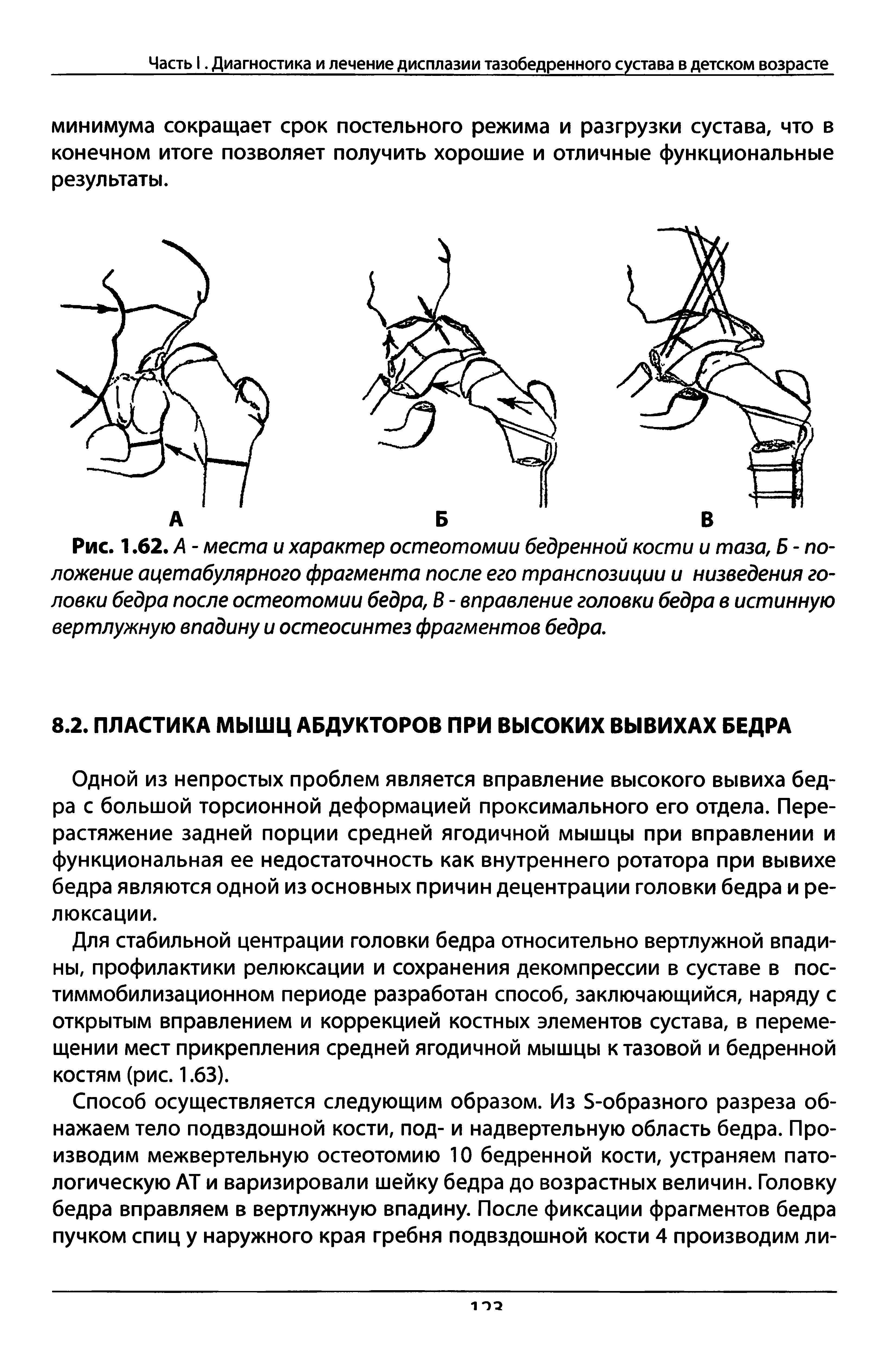 Рис. 1.62. А - места и характер остеотомии бедренной кости и таза, Б - положение ацетабулярного фрагмента после его транспозиции и низведения головки бедра после остеотомии бедра, В - вправление головки бедра в истинную вертлужную впадину и остеосинтез фрагментов бедра.