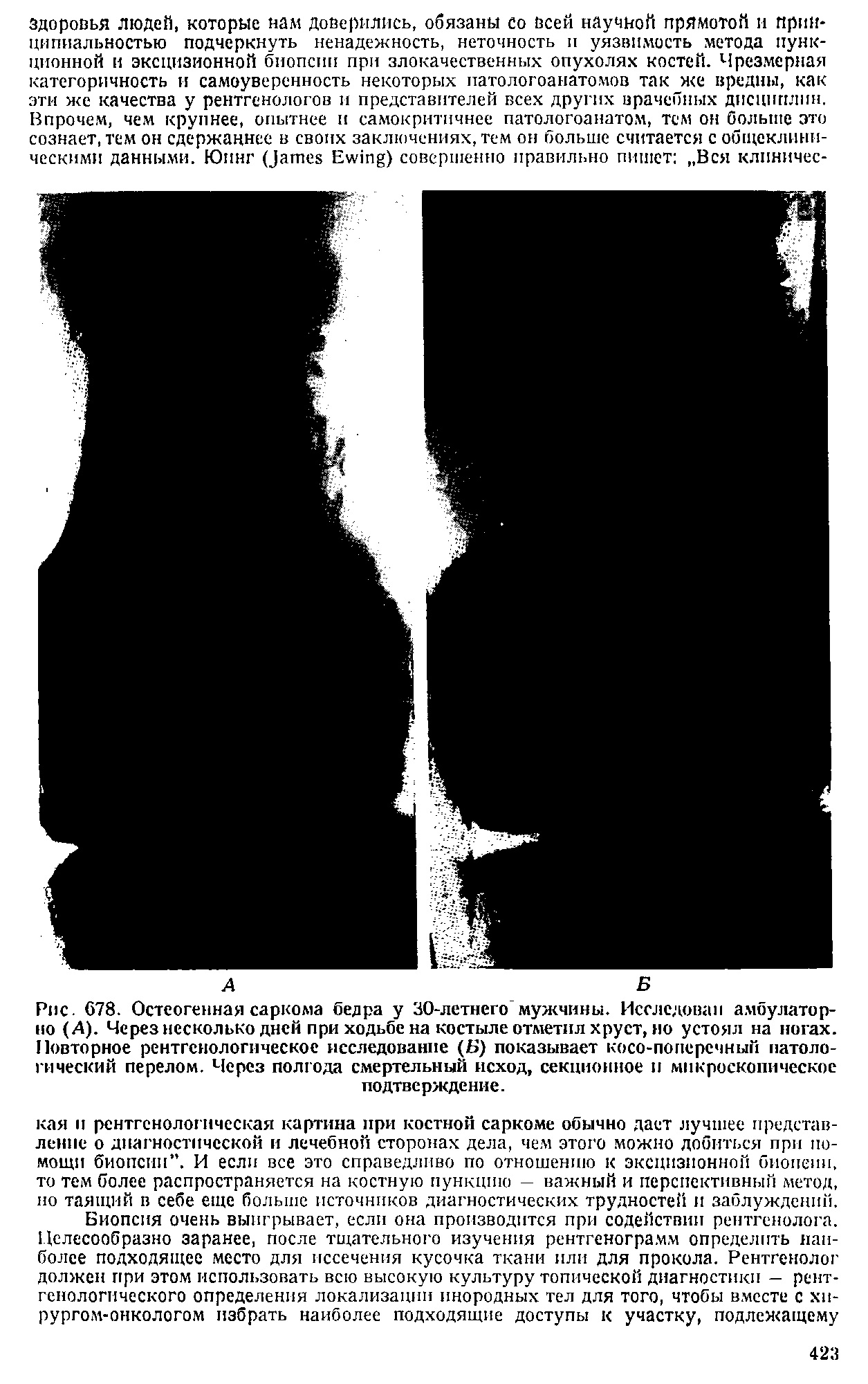 Рис. 678. Остеогенная саркома бедра у 30-летнего мужчины. Исследован амбулаторно (А). Через несколько дней при ходьбе на костыле отметил хруст, но устоял на ногах. Повторное рентгенологическое исследование (Б) показывает косо-поперечный патологический перелом. Через полгода смертельный исход, секционное и микроскопическое подтверждение.