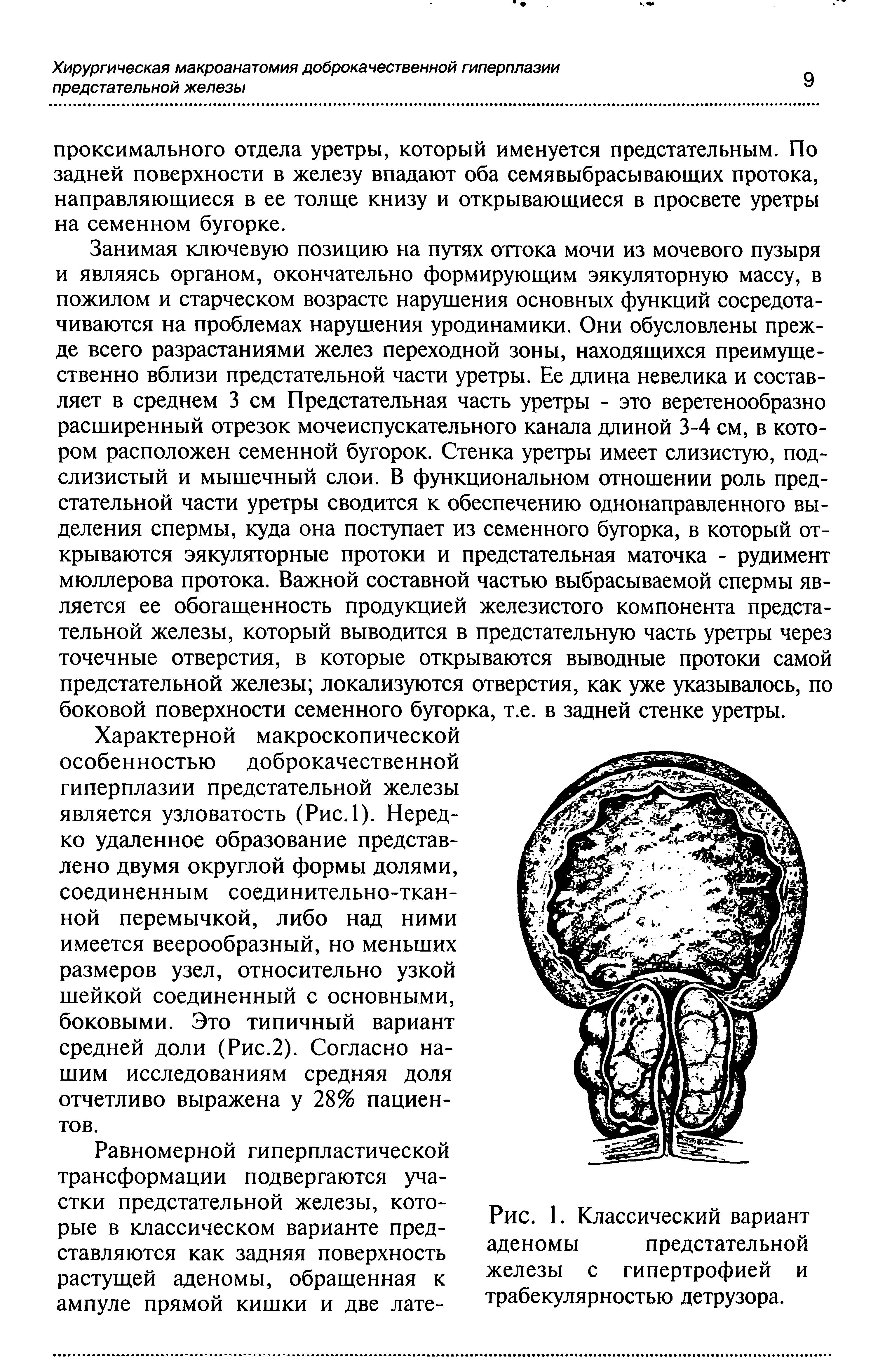 Рис. 1. Классический вариант аденомы предстательной железы с гипертрофией и трабекулярностью детрузора.