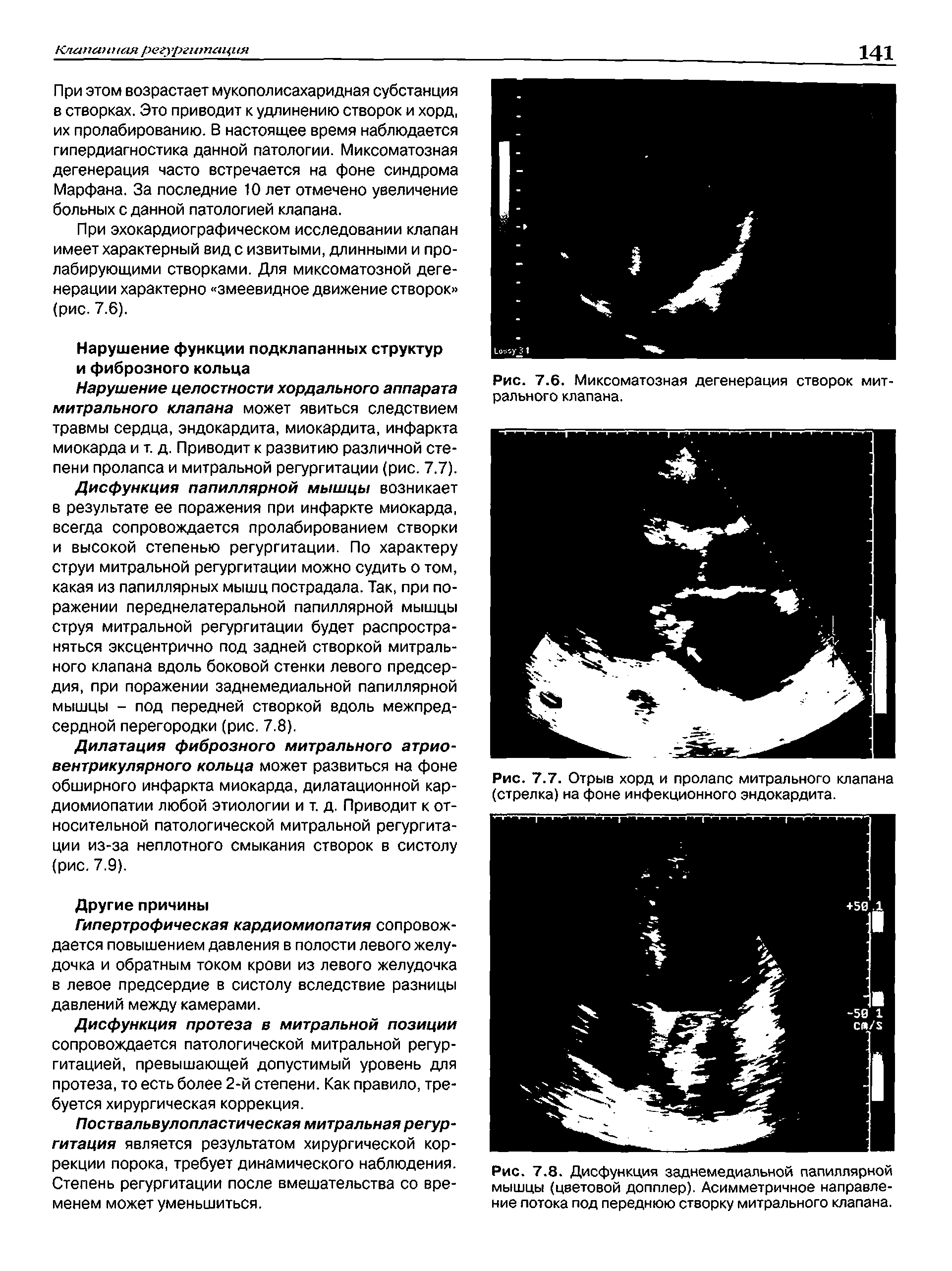 Рис. 7.7. Отрыв хорд и пролапс митрального клапана (стрелка) на фоне инфекционного эндокардита.