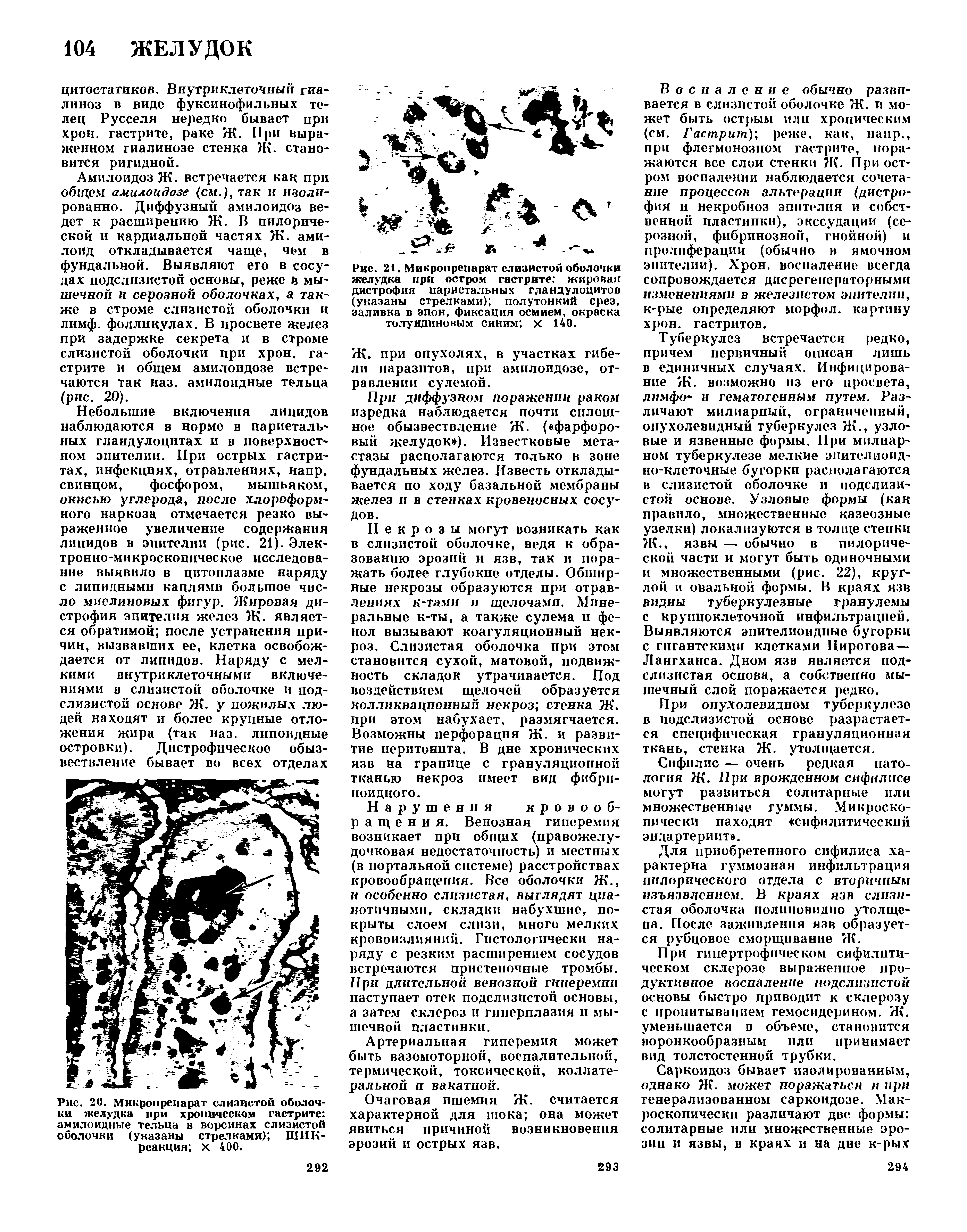 Рис. 21. Микропрепарат слизистой оболочки желудка при остром гастрите жировая дистрофия париетальных гландулоцитов (указаны стрелками) полутонкий срез, заливка в эпон, фиксация осмием, окраска толуидиновым синим х 140.