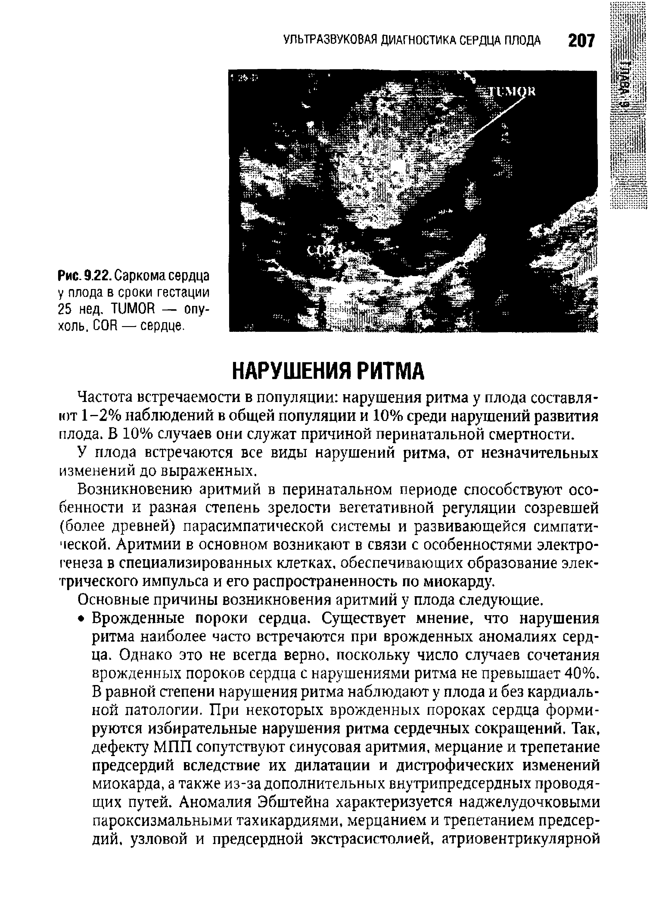 Рис. 9.22. Саркома сердца у плода в сроки гестации 25 нед. TUMOR — опухоль. COR — сердце.