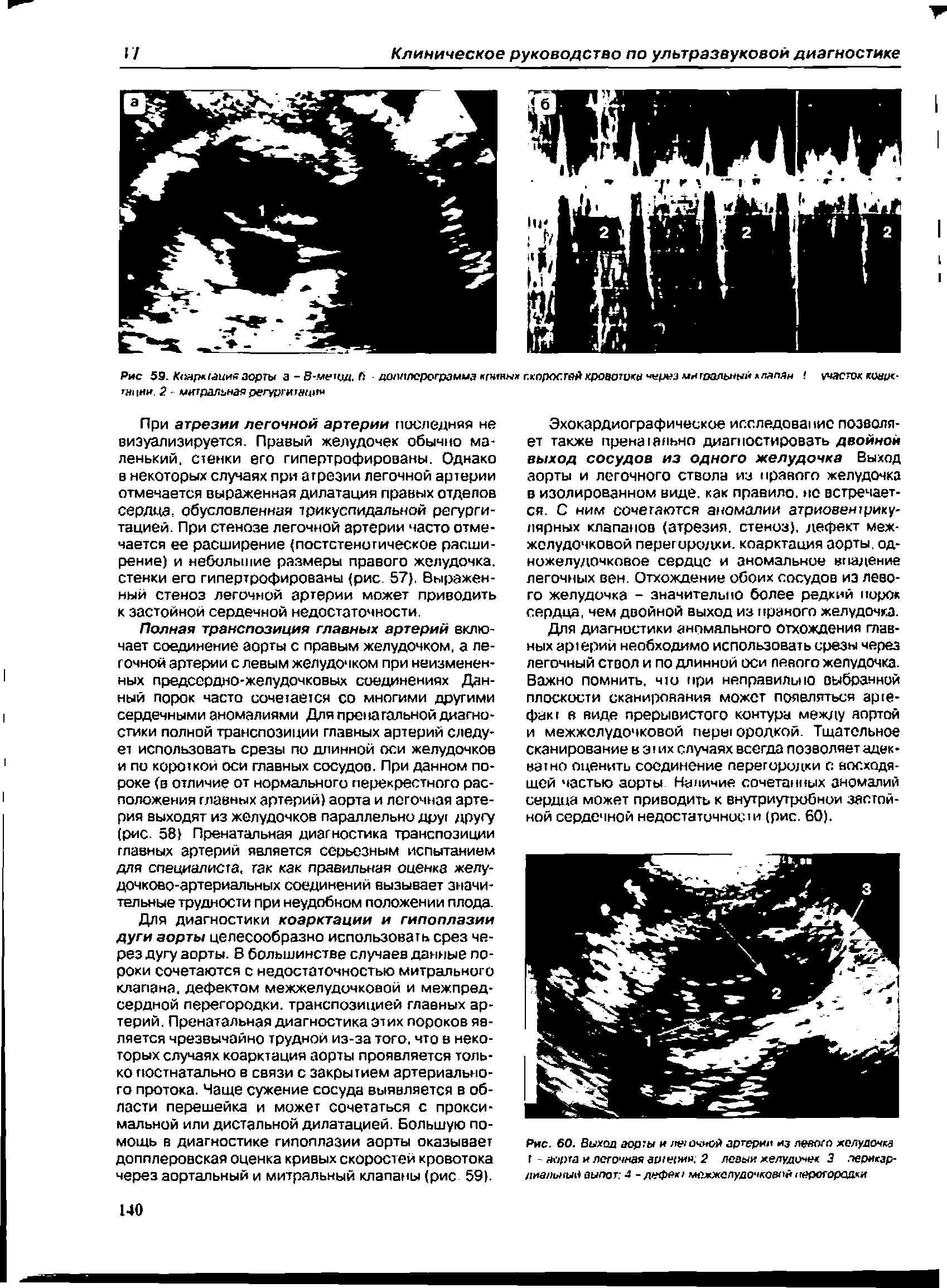 Рис. 60. Выход юрты и точной артерии из левого желудочки I - аорта и легочная ар/ерин 2 левый желудочек 3 перикардиальный выпот 4 -дефект межжелудочковой ггврегорецхки...