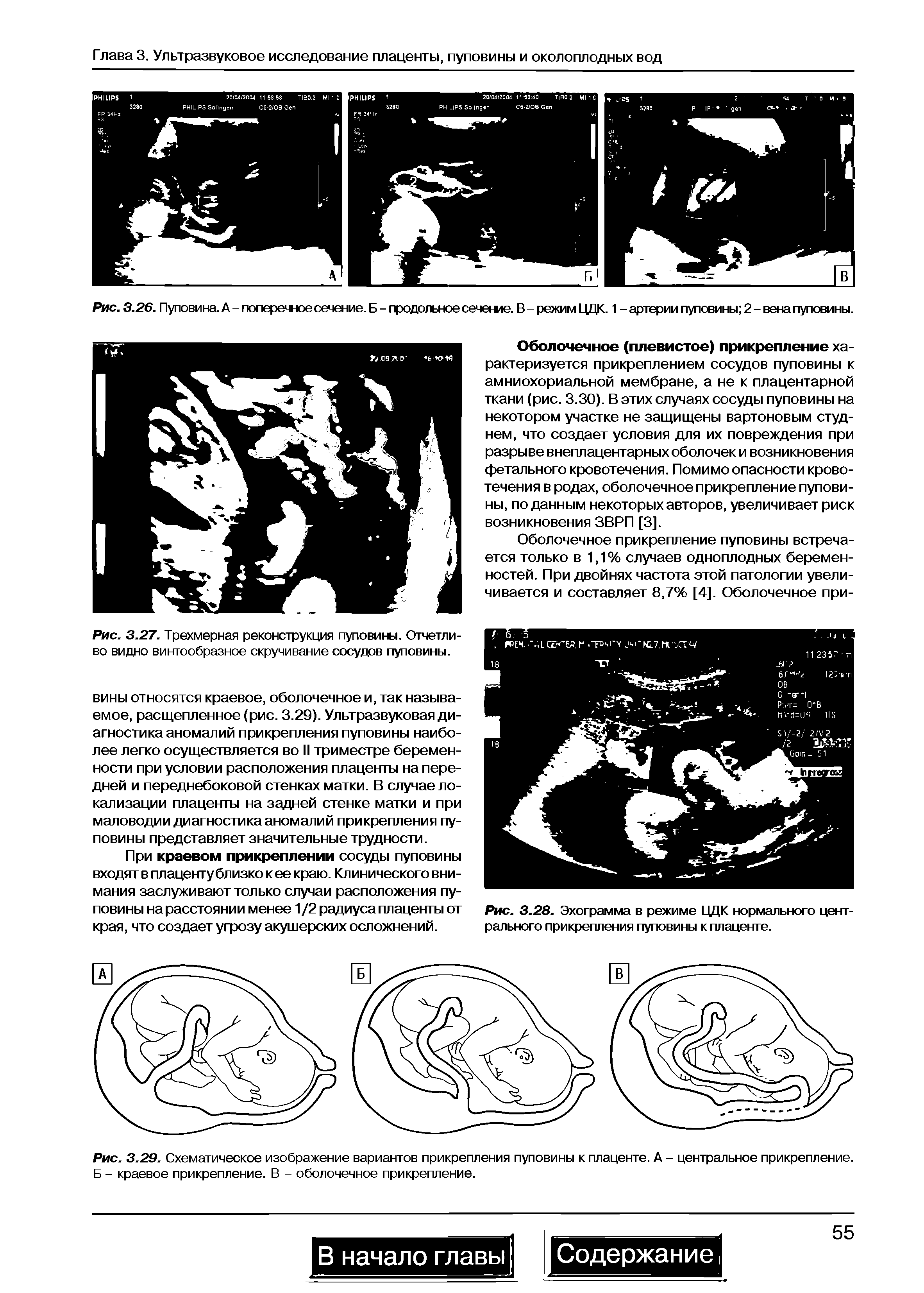 Рис. 3.29. Схематическое изображение вариантов прикрепления пуповины к плаценте. А - центральное прикрепление. Б - краевое прикрепление. В - оболочечное прикрепление.