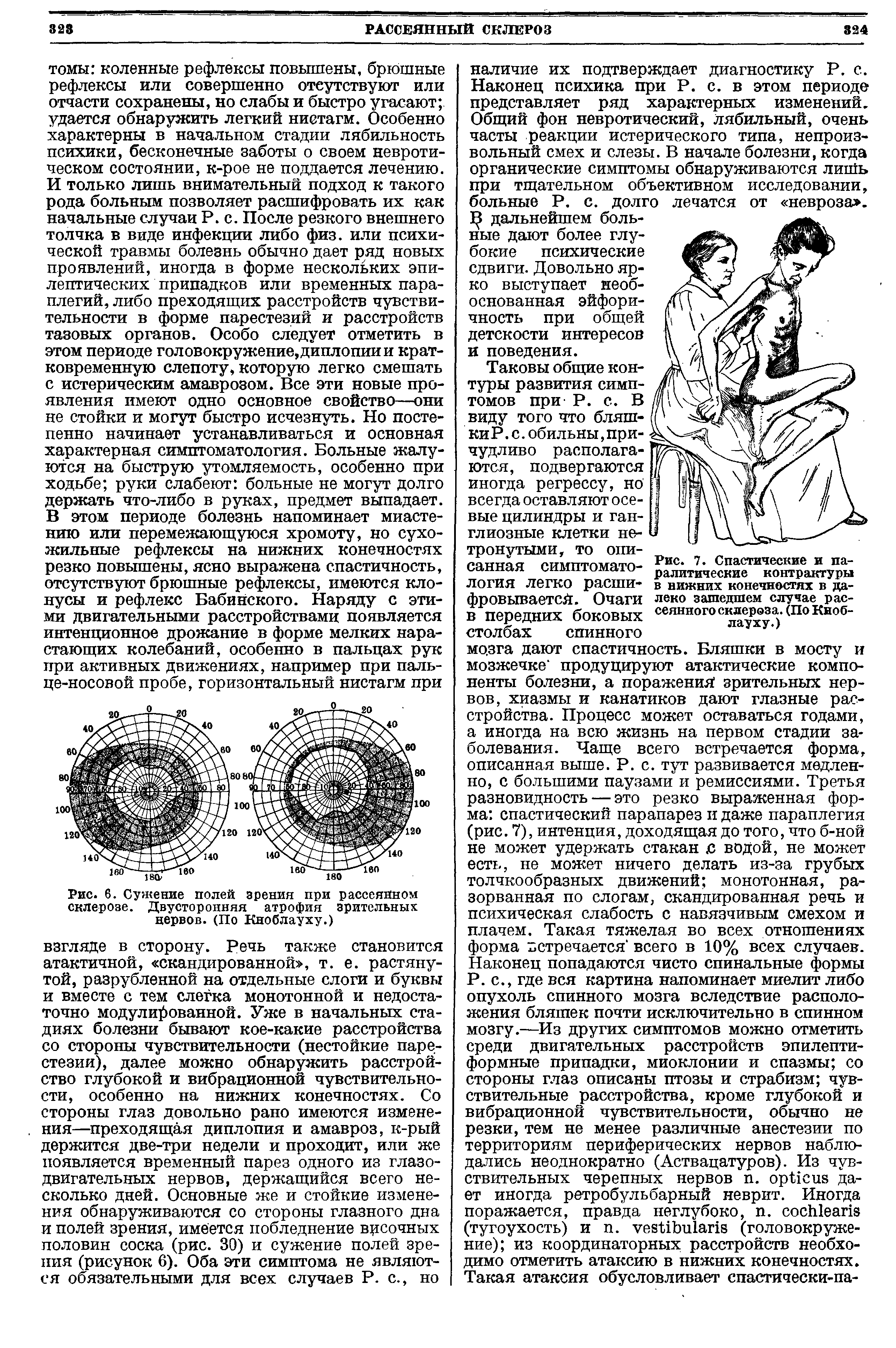 Рис. 6. Сужение полей зрения при рассеянном склерозе. Двусторонняя атрофия зрительных нервов. (По Кноблауху.)...