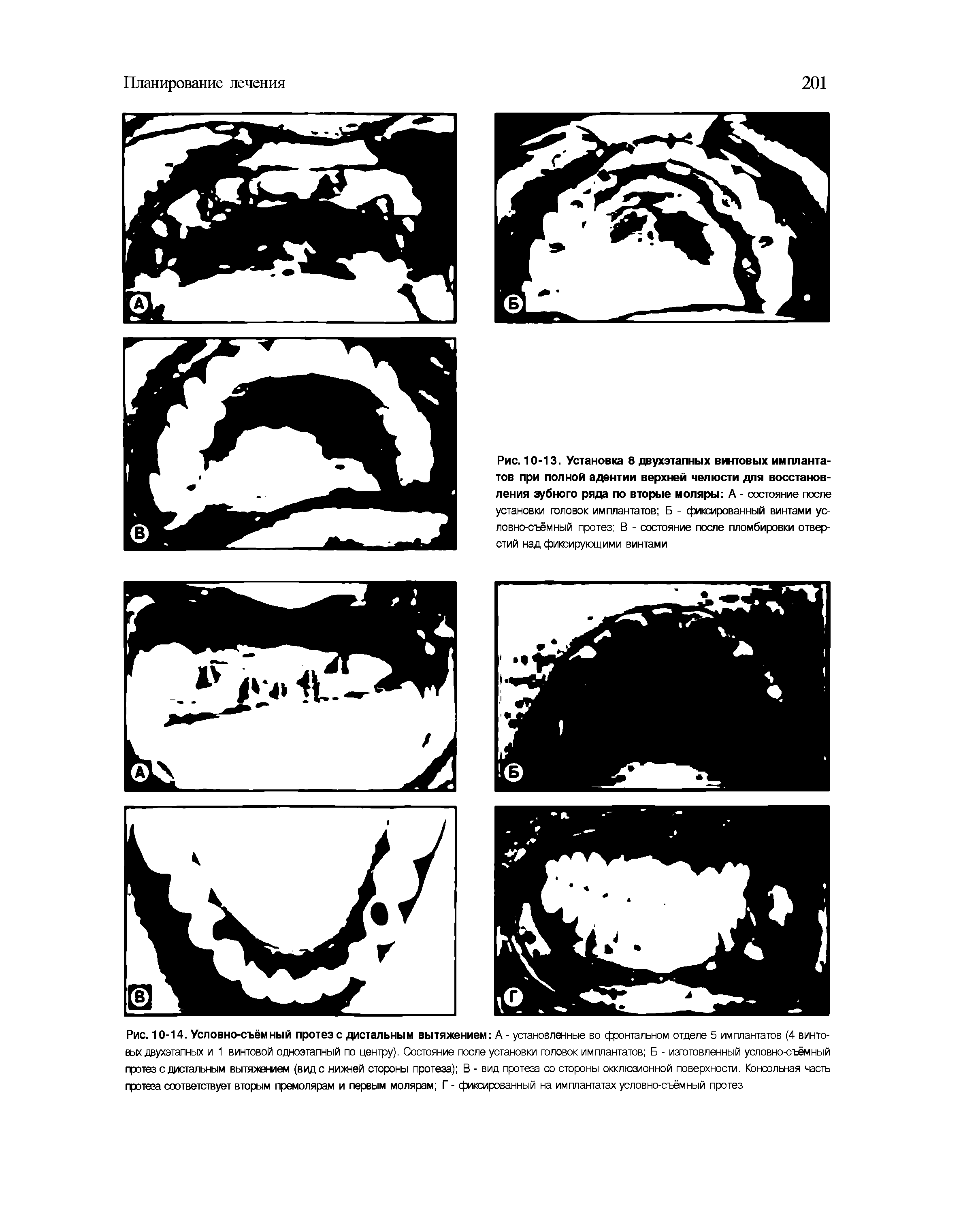 Рис. 10-13. Установка 8 двухэтапных винтовых имплантатов при полной адентии верхней челюсти для восстановления зубного ряда по вторые моляры А - состояние после установки головок имплантатов Б - фиксированный винтами условно-съёмный протез В - состояние после пломбировки отверстий над фиксирующими винтами...