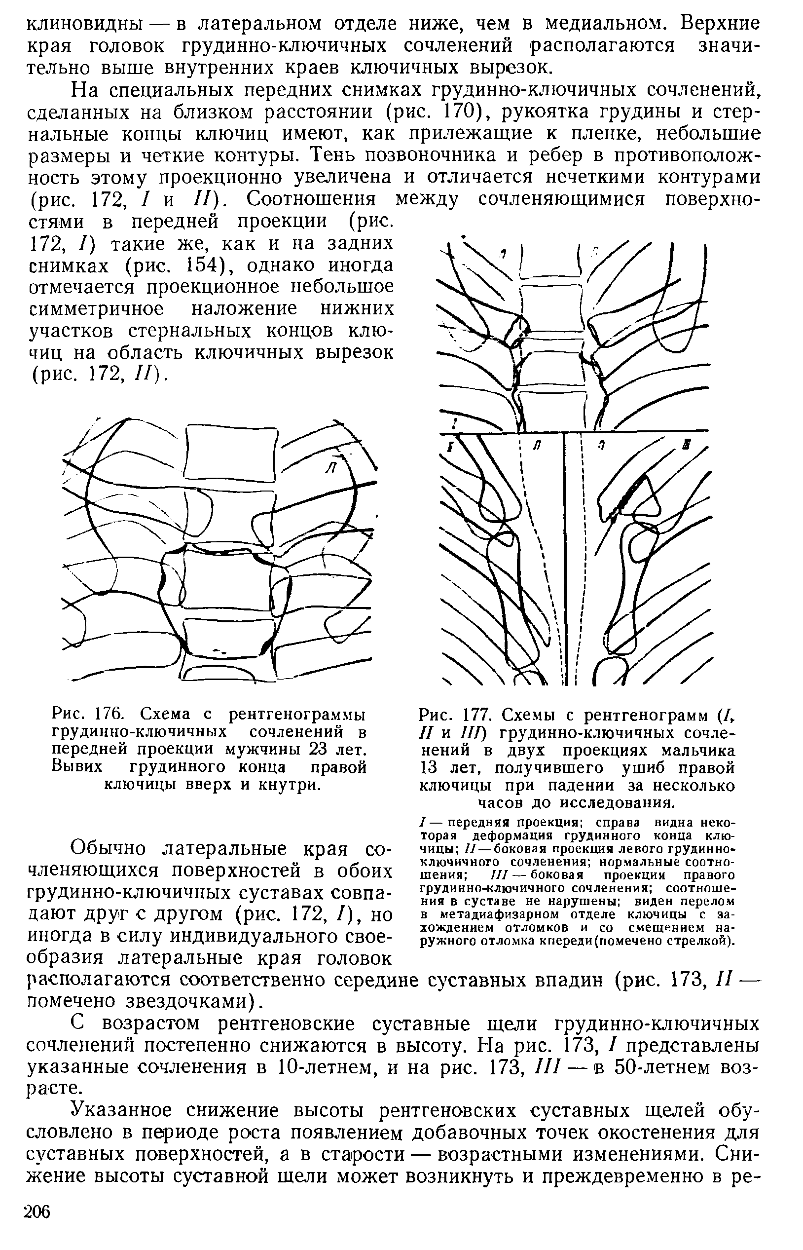 Рис. 176. Схема с рентгенограммы грудинно-ключичных сочленений в передней проекции мужчины 23 лет. Вывих грудинного конца правой ключицы вверх и кнутри.