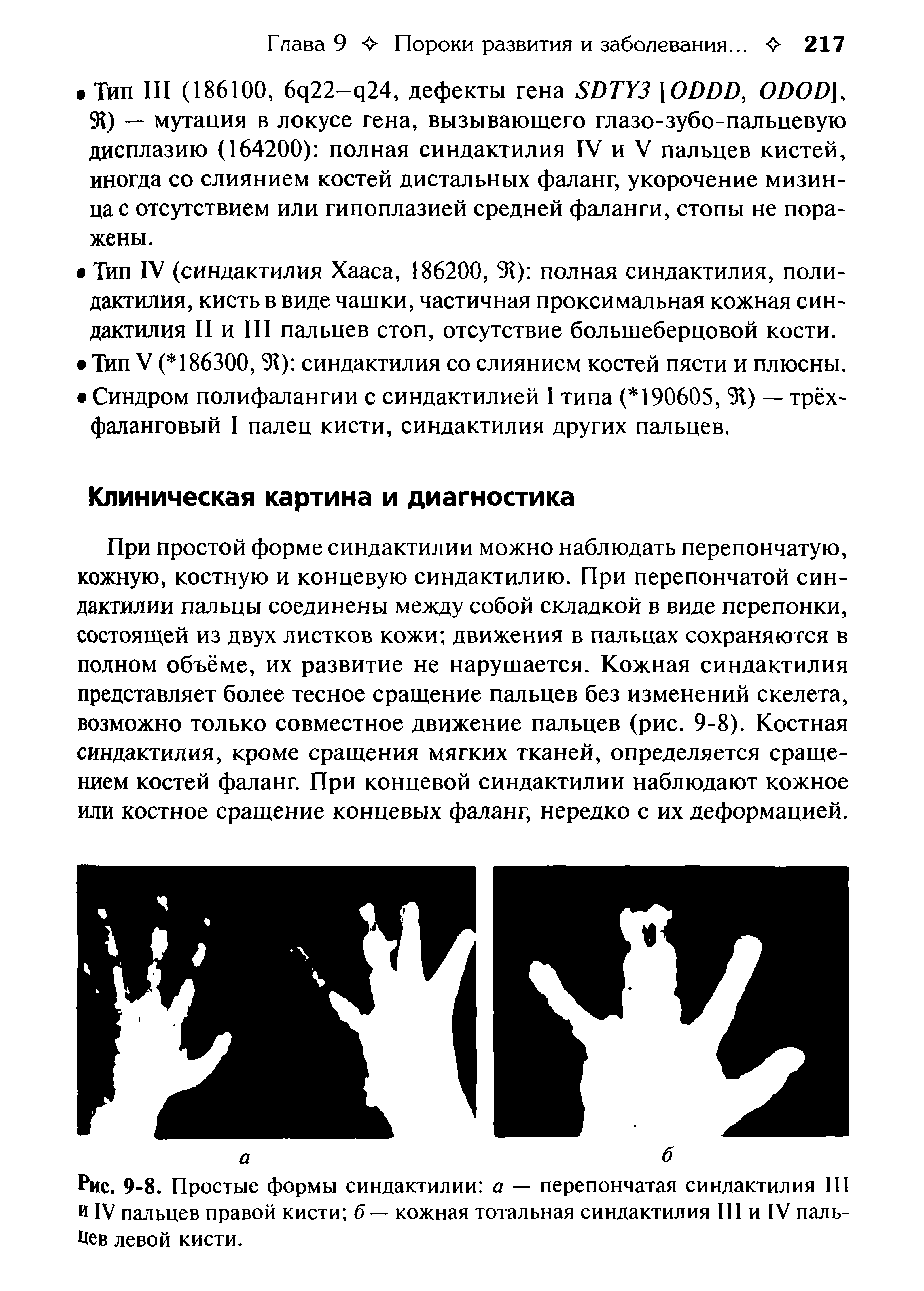 Рис. 9-8. Простые формы синдактилии а — перепончатая синдактилия III И IV пальцев правой кисти б — кожная тотальная синдактилия III и IV пальцев левой кисти.