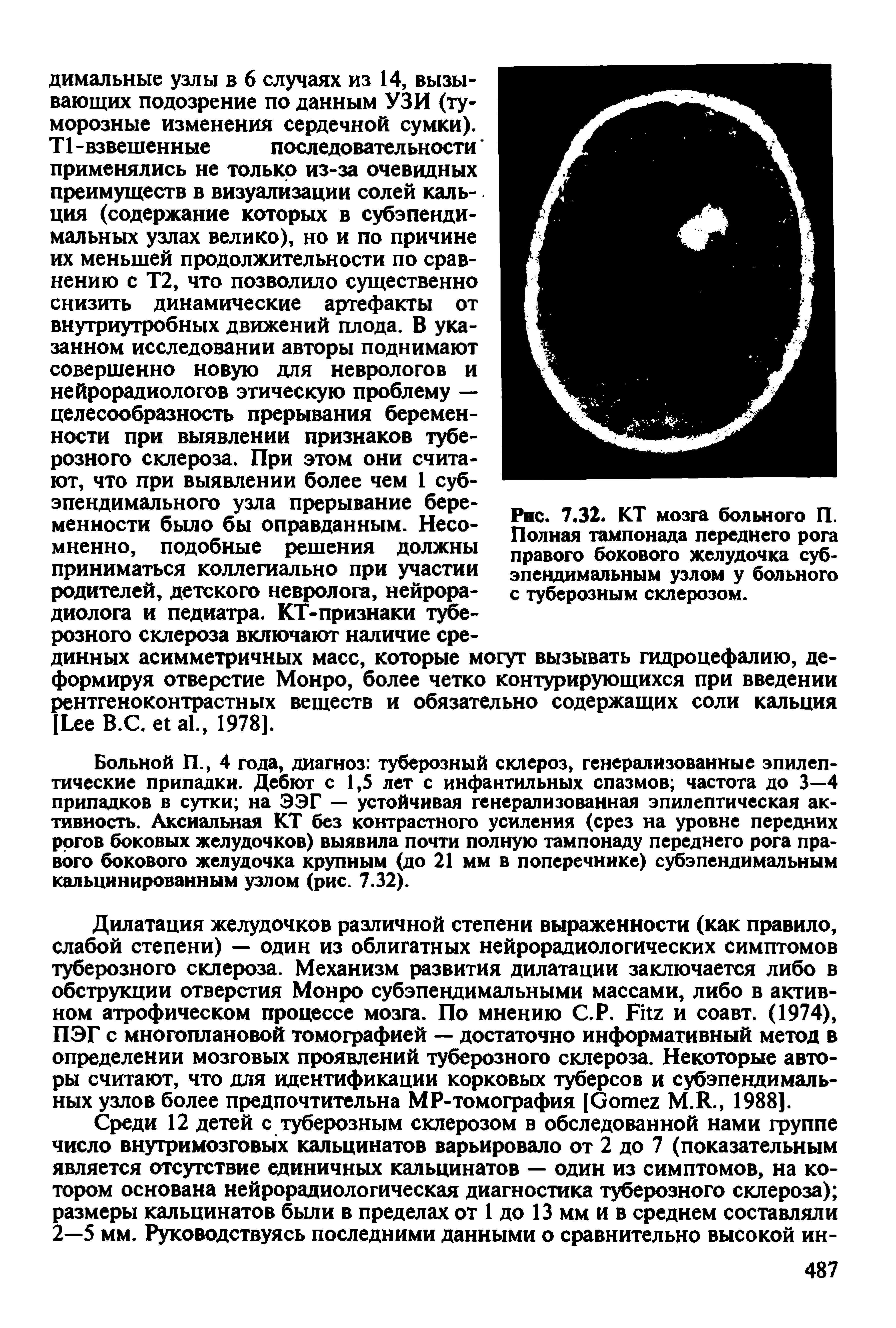 Рис. 7.32. КТ мозга больного П. Полная тампонада переднего рога правого бокового желудочка субэпендимальным узлом у больного с туберозным склерозом.