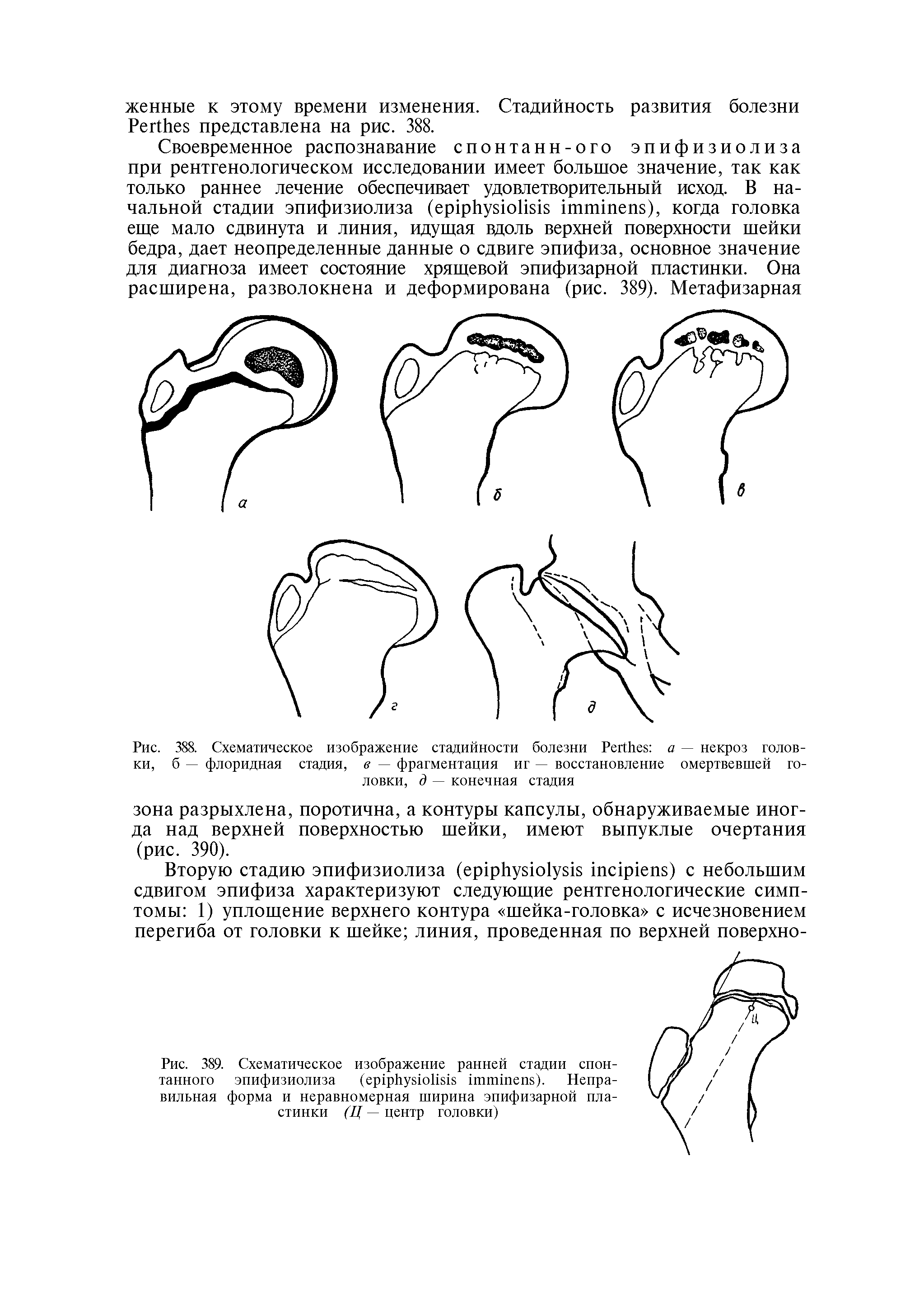 Рис. 388. Схематическое изображение стадийности болезни P а — некроз головки, б — флоридная стадия, в — фрагментация иг — восстановление омертвевшей головки, д — конечная стадия...