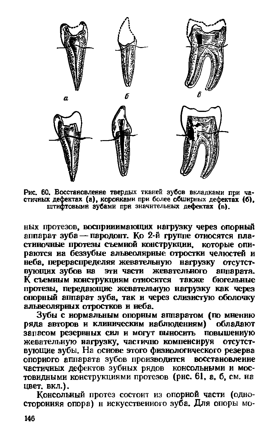 Рис. 60. Восстановление твердых тканей зубов вкладками при частичных дефектах (а), коронками при более обширных дефектах (б), штифтовыми зубами при значительных дефектах (в).