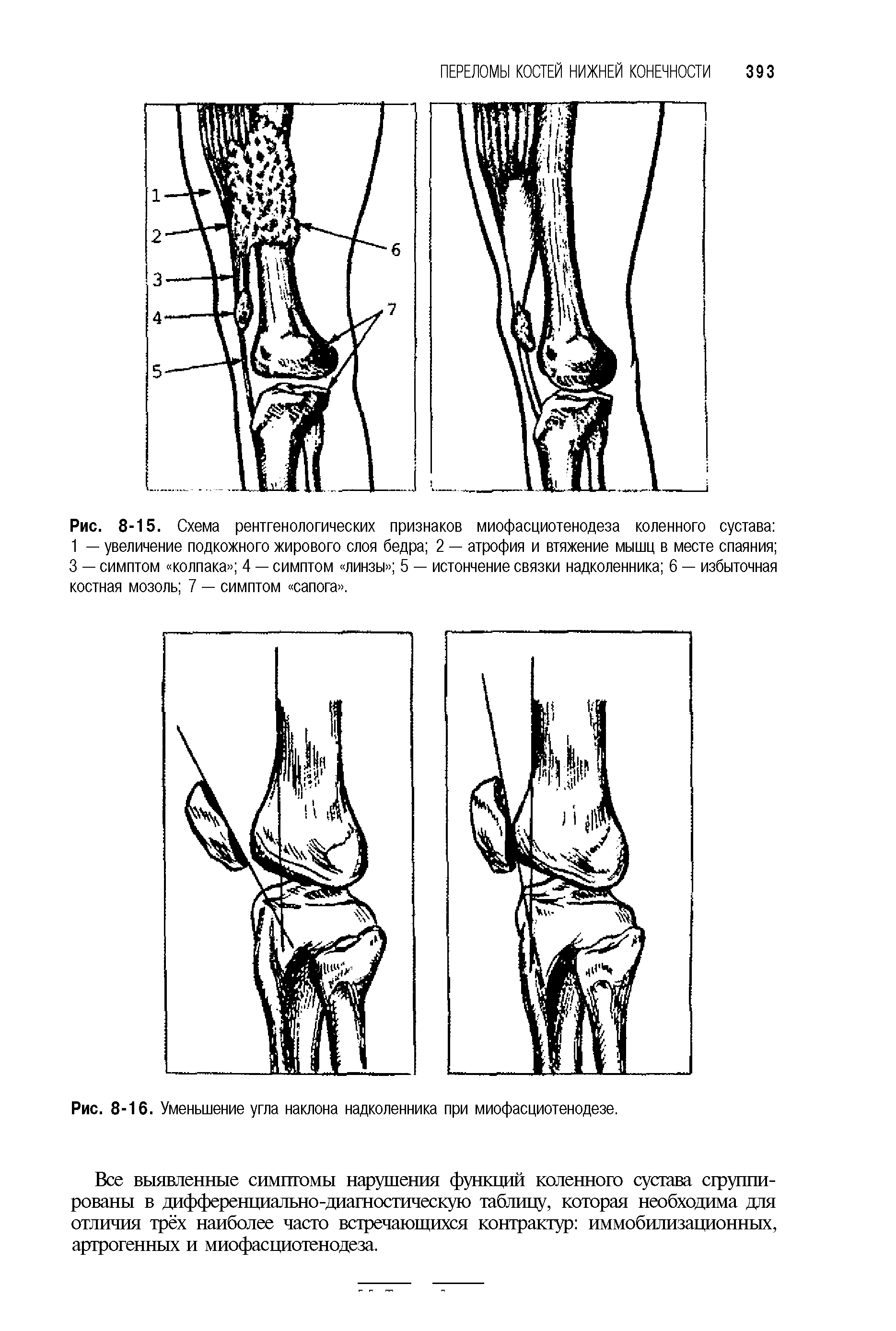 Рис. 8-15. Схема рентгенологических признаков миофасциотенодеза коленного сустава 1 — увеличение подкожного жирового слоя бедра 2 — атрофия и втяжение мышц в месте спаяния 3 — симптом колпака 4 — симптом линзы 5 — истончение связки надколенника 6 — избыточная костная мозоль 7 — симптом сапога .