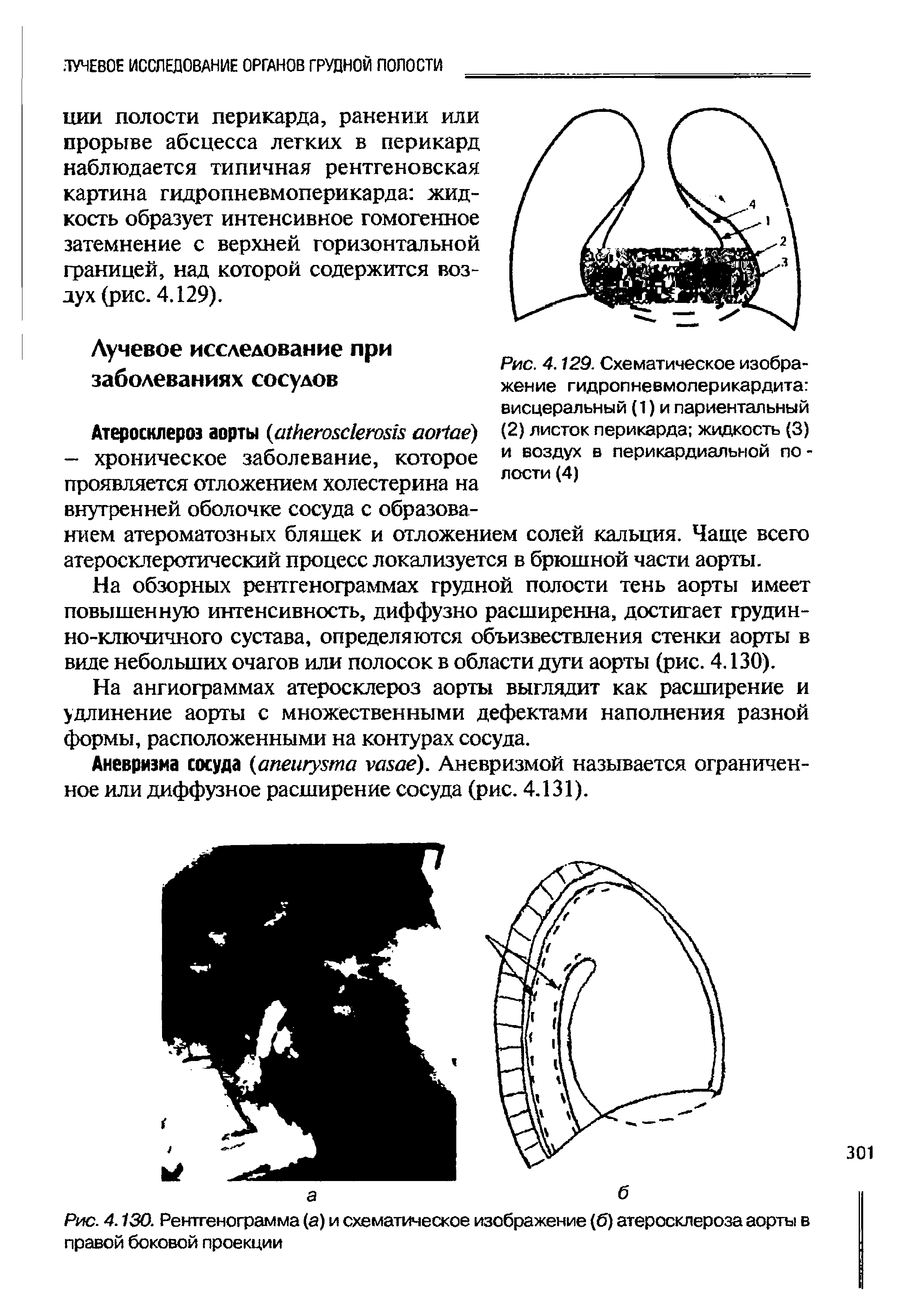 Рис. 4.129. Схематическое изображение гидропневмолерикардита висцеральный (1) и париентальный (2) листок перикарда жидкость (3) и воздух в перикардиальной по -л ости (4)...