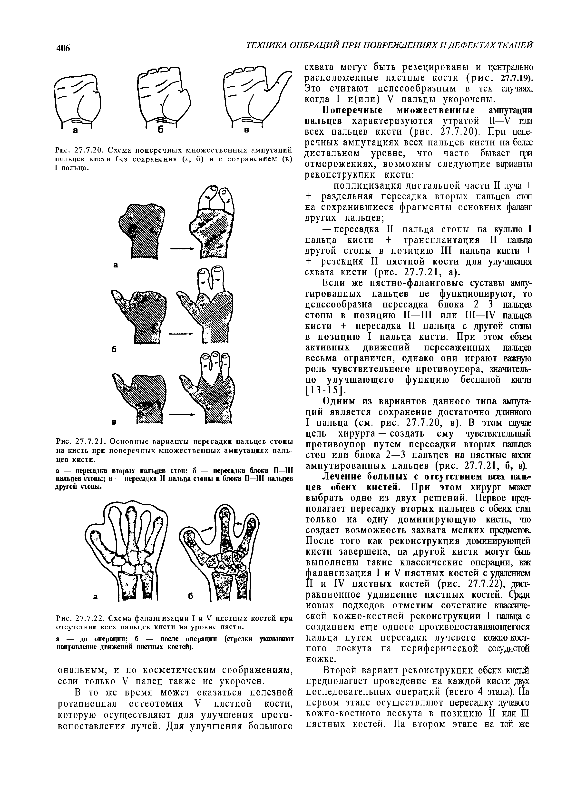 Рис. 27.7.21. Основные варианты пересадки пальцев стопы на кисть при поперечных множественных ампутациях пальцев кисти.