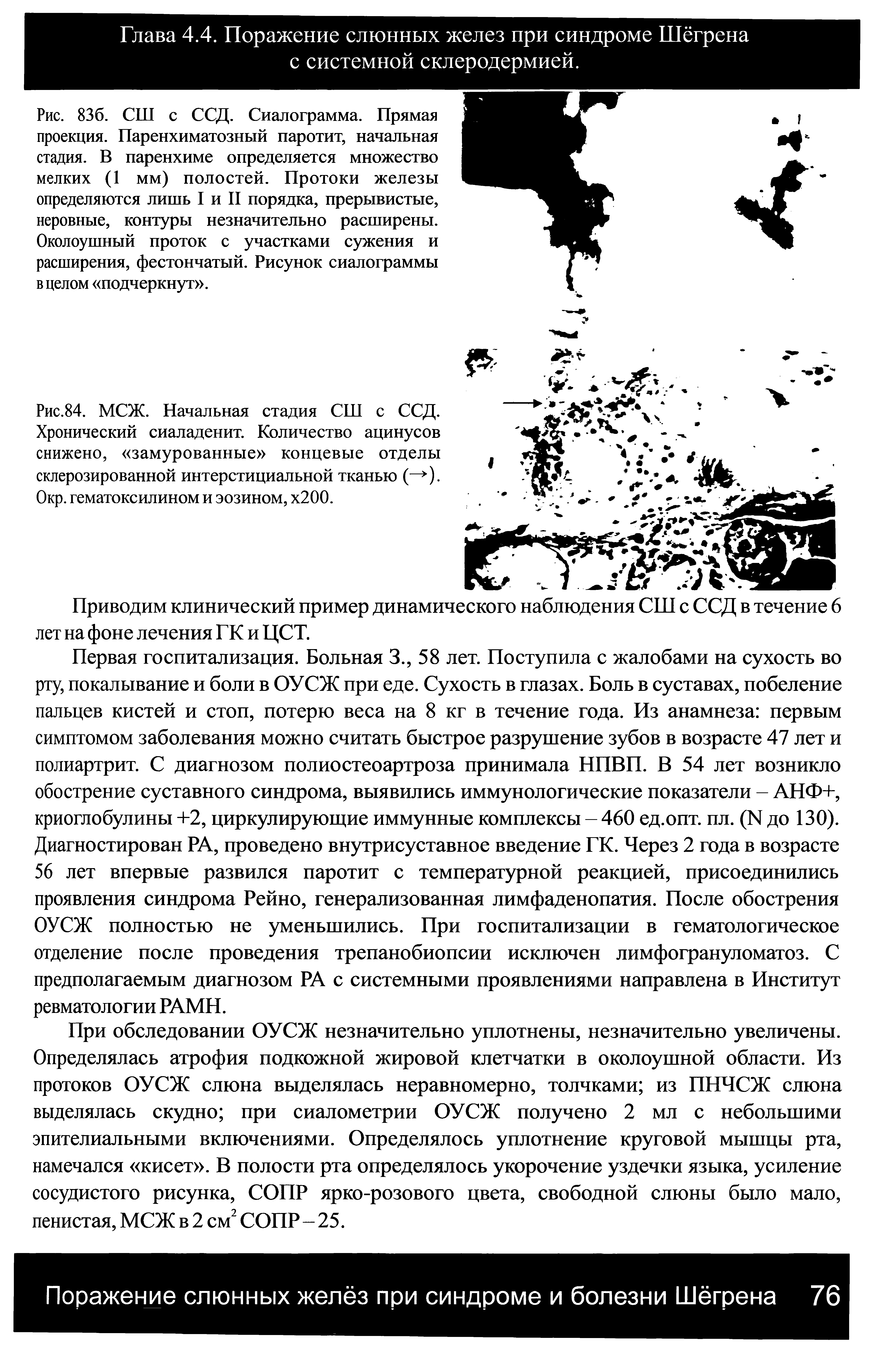 Рис.84. МСЖ. Начальная стадия СШ с ССД. Хронический сиаладенит. Количество ацинусов снижено, замурованные концевые отделы склерозированной интерстициальной тканью ( ). Окр. гематоксилином и эозином, х200.