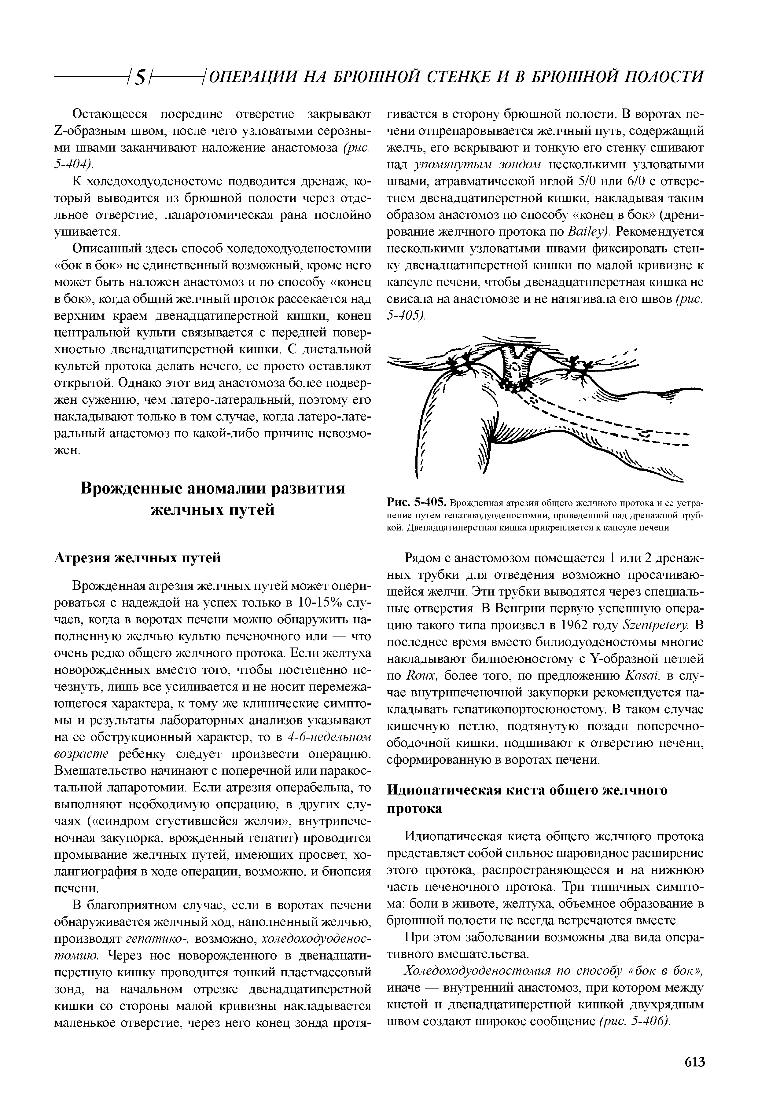 Рис. 5-405. Врожденная атрезия общего желчного протока и ее устра-нение путем гепатикодуоденостомии, проведенной над дренажной трубкой. Двенадцатиперстная кишка прикрепляется к капсуле печени...