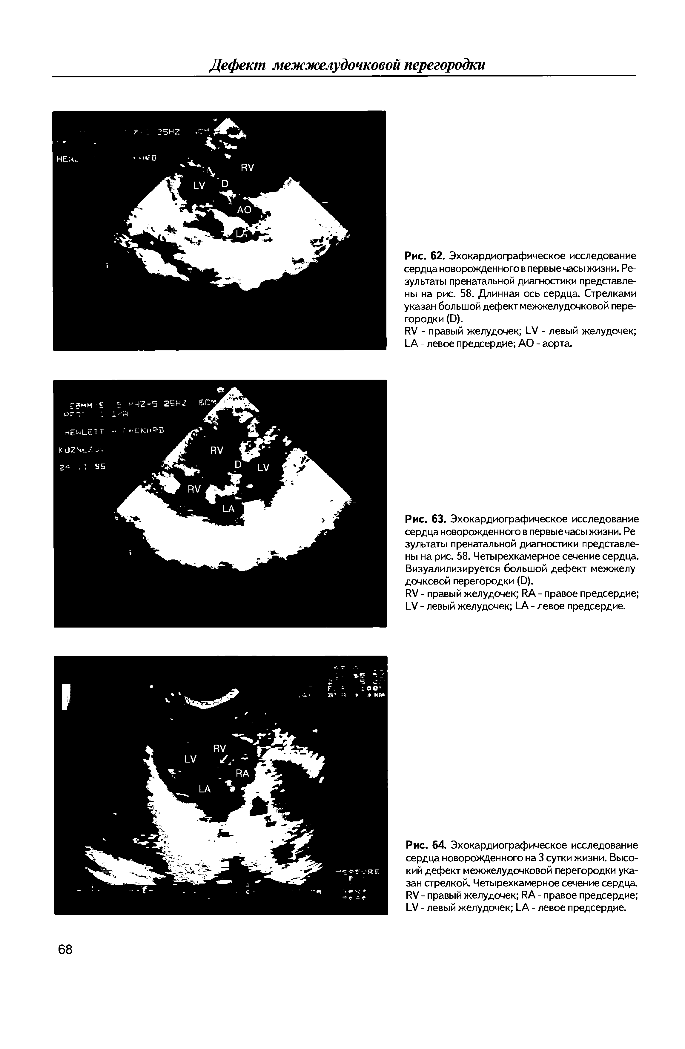 Рис. 64. Эхокардиографическое исследование сердца новорожденного на 3 сутки жизни. Высокий дефект межжелудочковой перегородки указан стрелкой. Четырехкамерное сечение сердца. / - правый желудочек А - правое предсердие ЬУ - левый желудочек 1 А - левое предсердие.