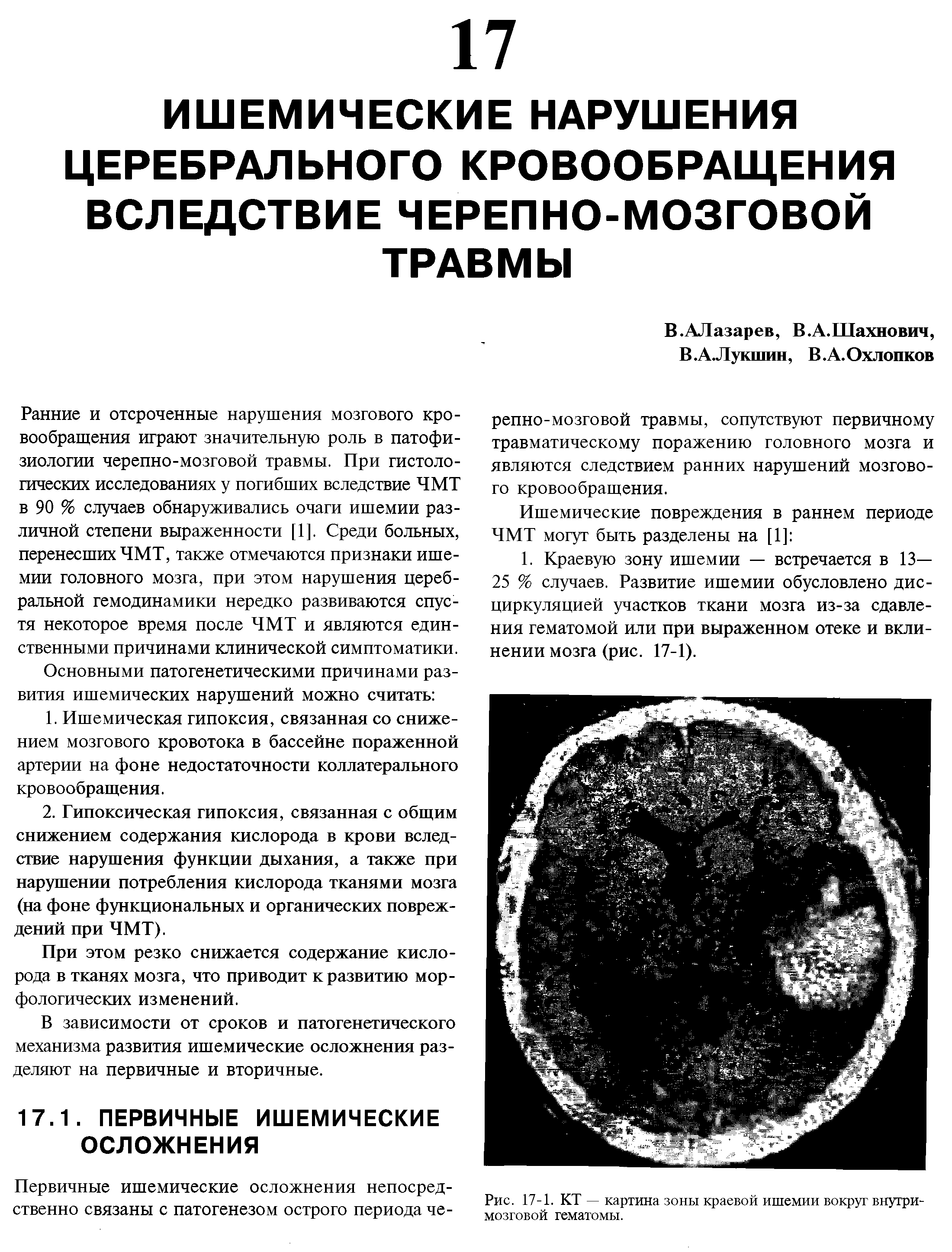 Рис. 17-1. КТ — картина зоны краевой ишемии вокруг внутримозговой гематомы.