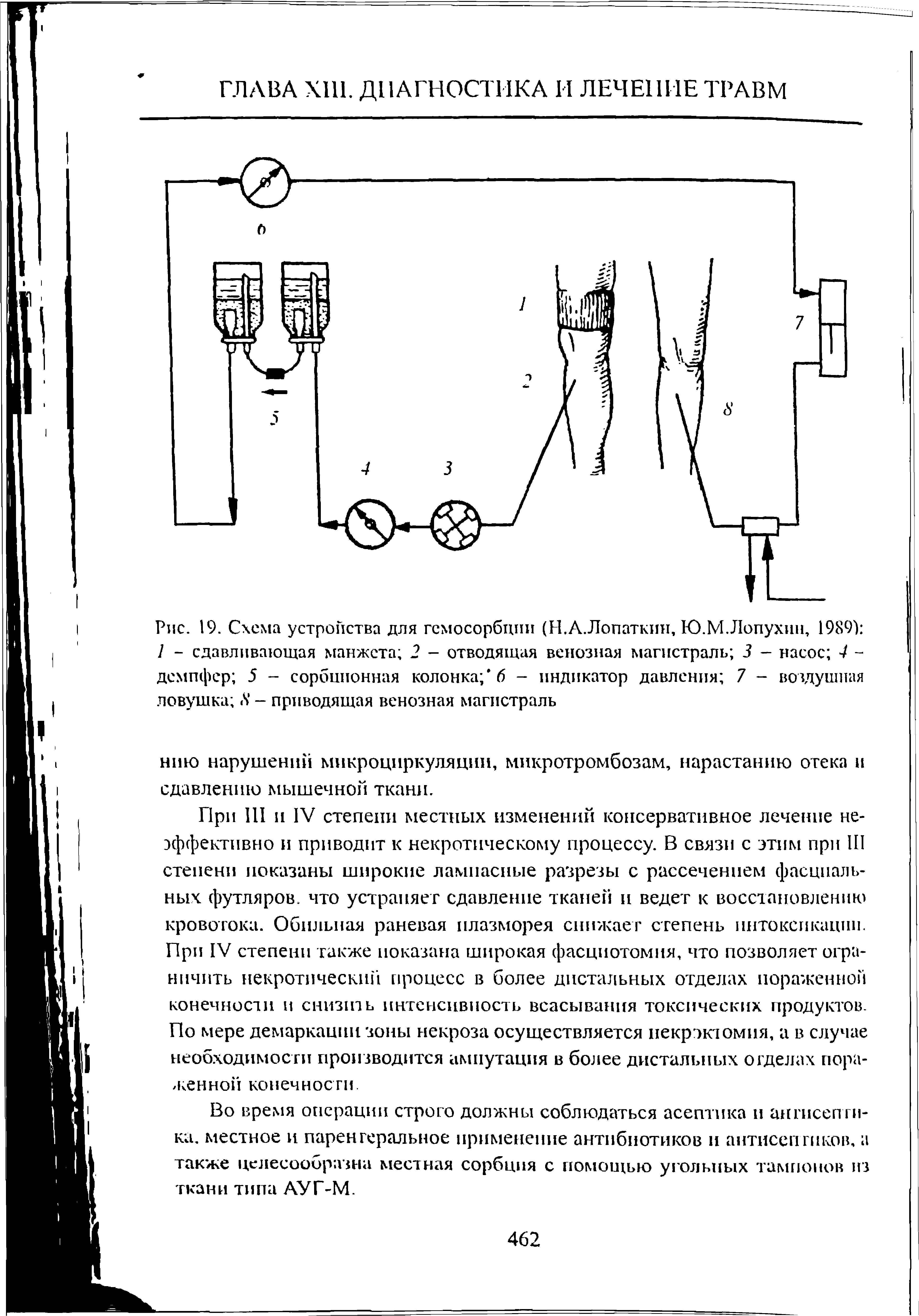 Рис. 19. Схема устройства для гсмосорбции (Н.А.Лопаткин, Ю.М.Лопухин, 1989) I - сдавливающая манжета 2 - отводящая венозная магистраль 3 - насос 4 -демпфер 5 - сорбционная колонка/ 6 - индикатор давления 7 - воздушная ловушка Л - приводящая венозная магистраль...