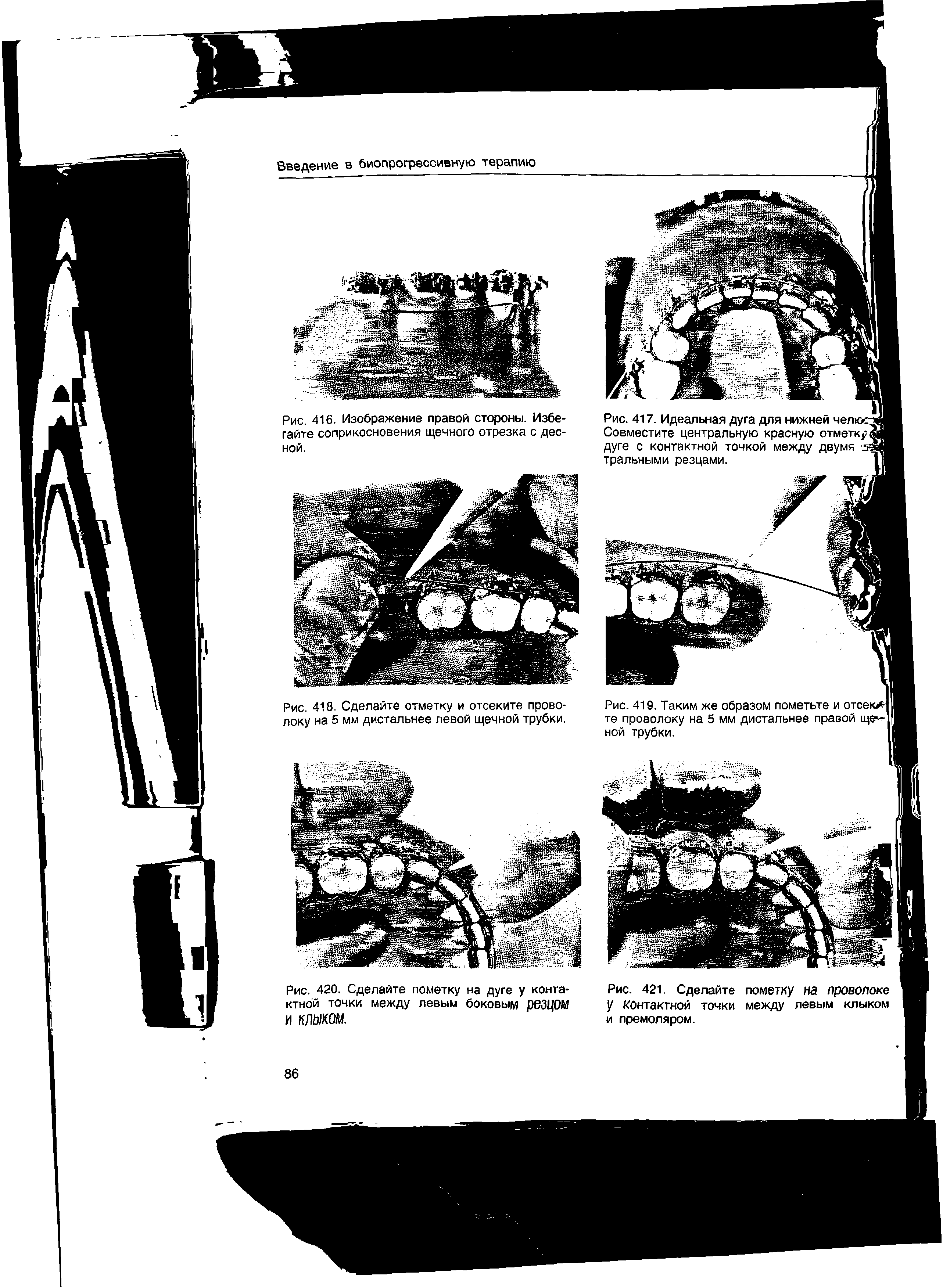 Рис. 417. Идеальная дуга для нижней челке Совместите центральную красную отметку дуге с контактной точкой между двумя . тральными резцами.