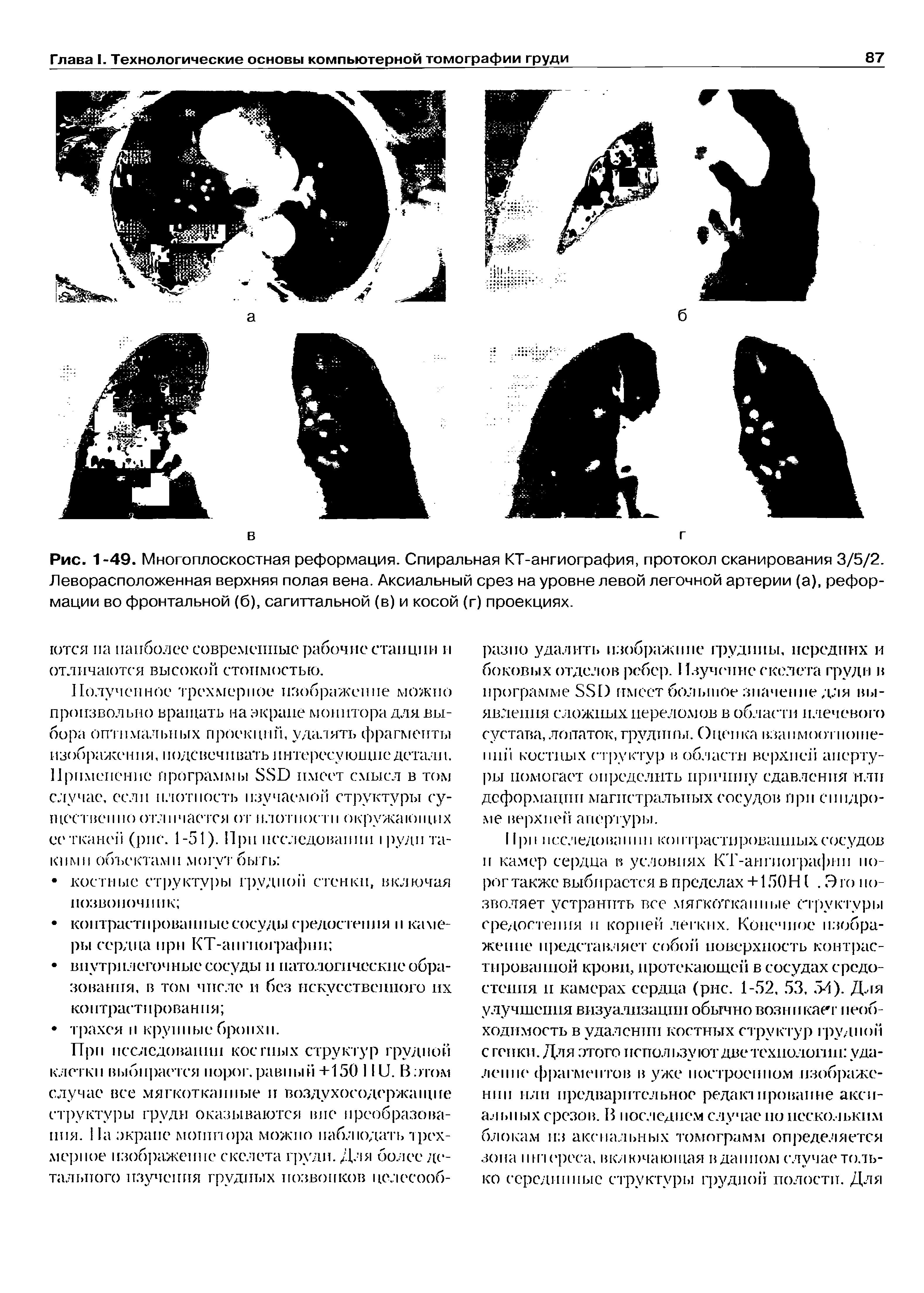 Рис. 1-49. Многоплоскостная реформация. Спиральная КТ-ангиография, протокол сканирования 3/5/2. Леворасположенная верхняя полая вена. Аксиальный срез на уровне левой легочной артерии (а), реформации во фронтальной (б), сагиттальной (в) и косой (г) проекциях.