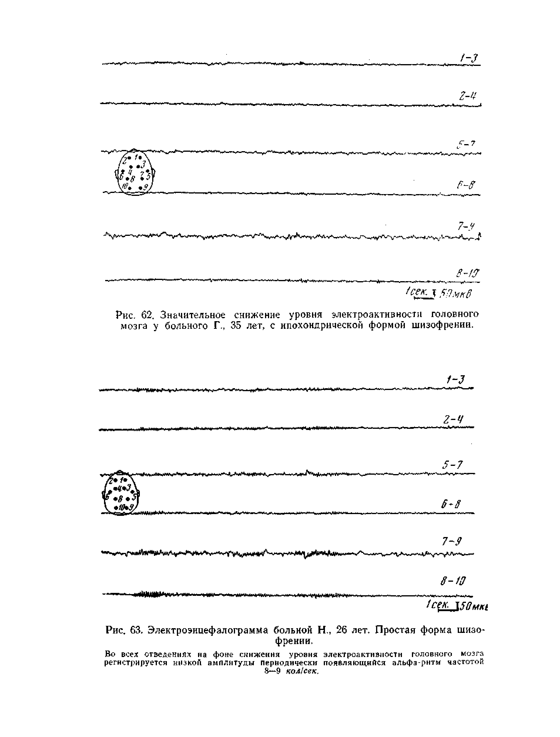 Рис. 62. Значительное снижение уровня электро актив кости головного мозга у больного Г 35 лет, с ипохондрической формой шизофрении.