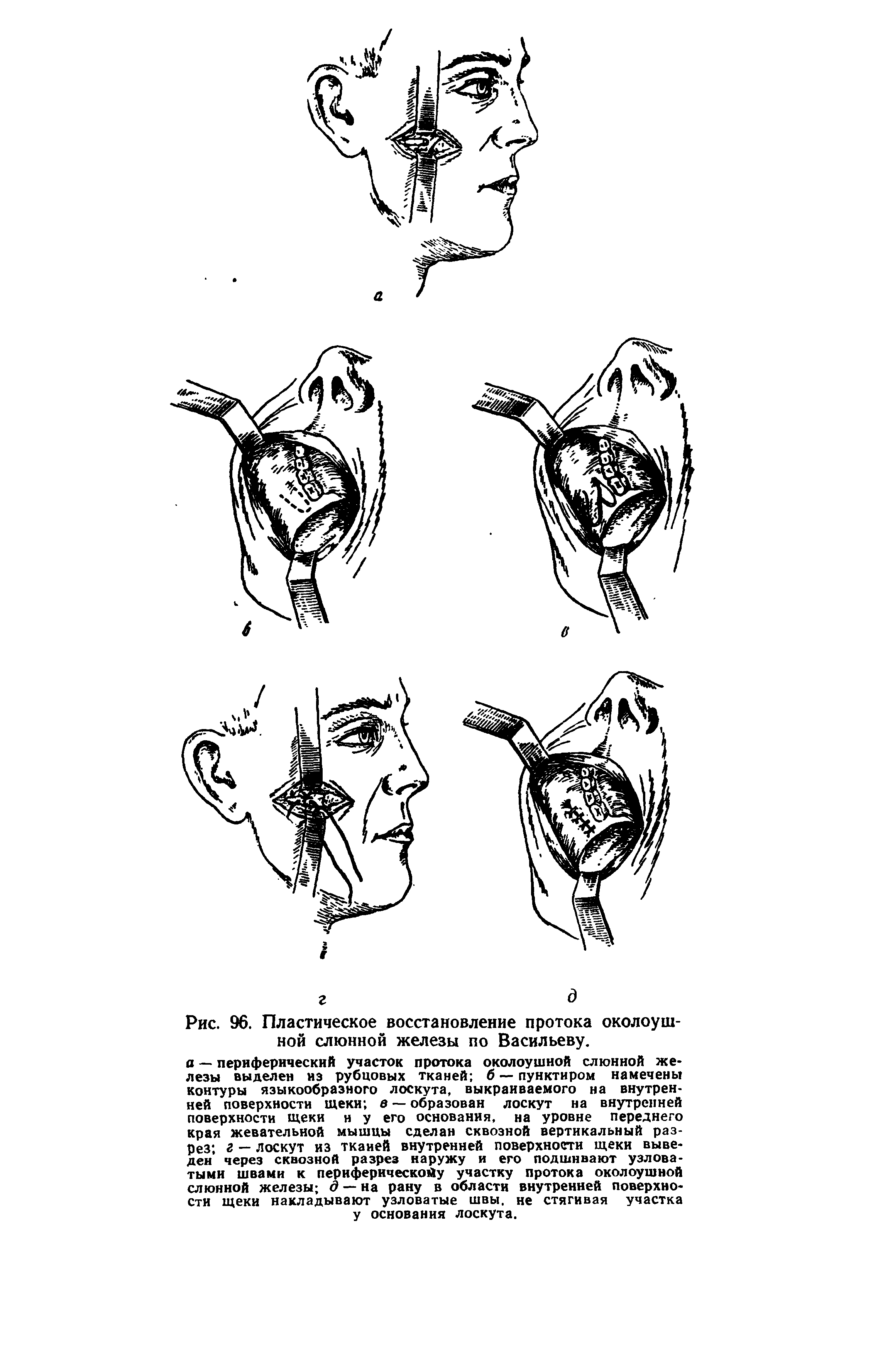 Рис. 96. Пластическое восстановление протока околоушной слюнной железы по Васильеву.