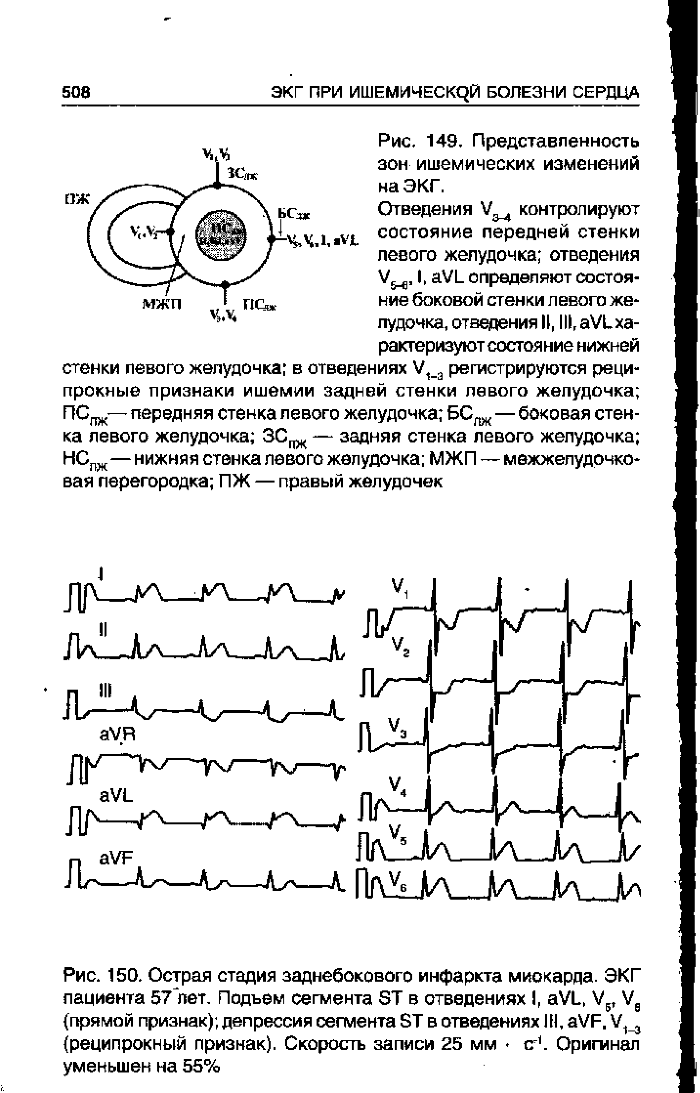 Рис. 150. Острая стадия заднебокового инфаркта миокарда. ЭКГ пациента 57 лет. Подъем сегмента 5Т в отведениях I, аХ/Ь, /5, Уе (прямой признак) депрессия сегмента 5Т в отведениях III, аХ/Я. Х/м (реципрокный признак). Скорость записи 25 мм си. Оригинал уменьшен на 55%...