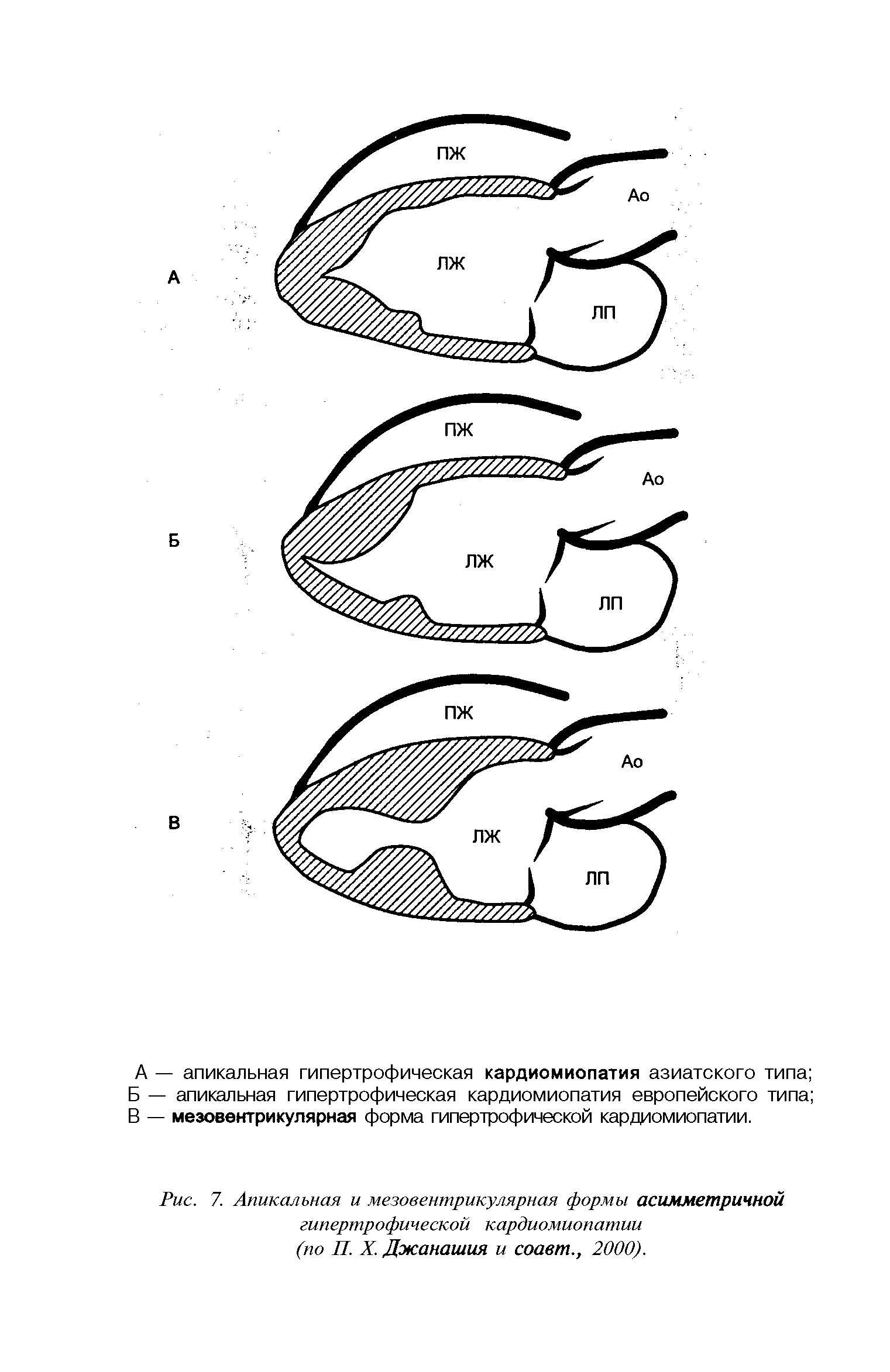 Рис. 7. Апикальная и мезовентрикулярная формы асимметричной гипертрофической кардиомиопатии (по П. X. Джанашия и соавт., 2000).