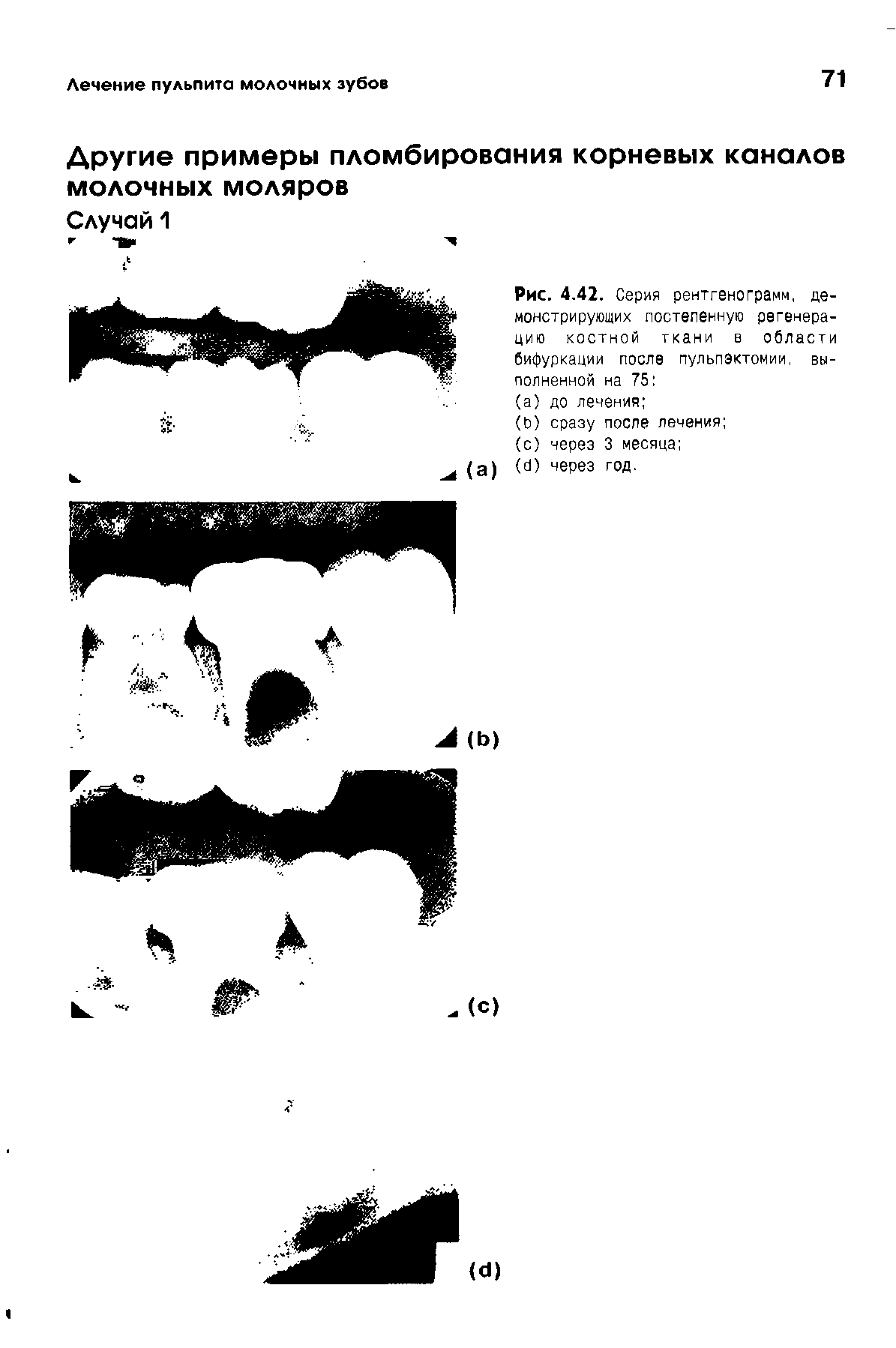 Рис. 4.42. Серия рентгенограмм, демонстрирующих постепенную регенерацию костной ткани в области бифуркации после пульпэктомии, выполненной на 75 ...